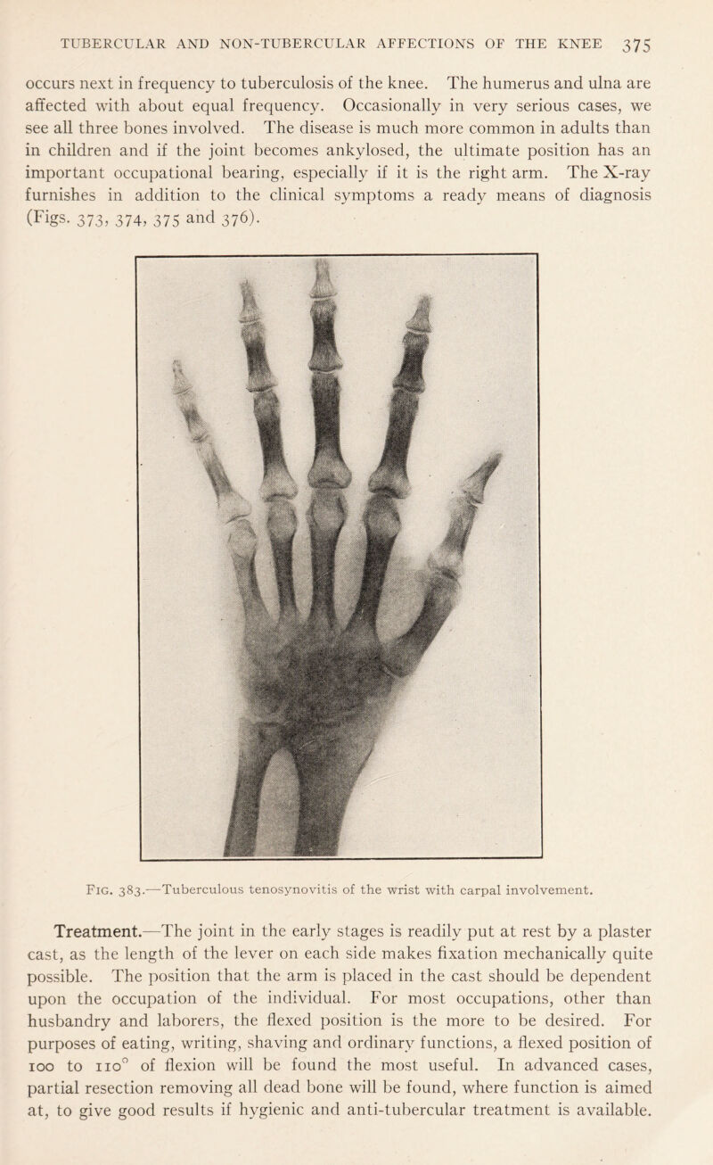 occurs next in frequency to tuberculosis of the knee. The humerus and ulna are affected with about equal frequency. Occasionally in very serious cases, we see all three bones involved. The disease is much more common in adults than in children and if the joint becomes ankylosed, the ultimate position has an important occupational bearing, especially if it is the right arm. The X-ray furnishes in addition to the clinical symptoms a ready means of diagnosis (Figs. 373, 374, 375 and 376). Fig. 383.—Tuberculous tenosynovitis of the wrist with carpal involvement. Treatment.—The joint in the early stages is readily put at rest by a plaster cast, as the length of the lever on each side makes fixation mechanically quite possible. The position that the arm is placed in the cast should be dependent upon the occupation of the individual. For most occupations, other than husbandry and laborers, the flexed position is the more to be desired. For purposes of eating, writing, shaving and ordinary functions, a flexed position of 100 to iio° of flexion will be found the most useful. In advanced cases, partial resection removing all dead bone will be found, where function is aimed at, to give good results if hygienic and anti-tubercular treatment is available.