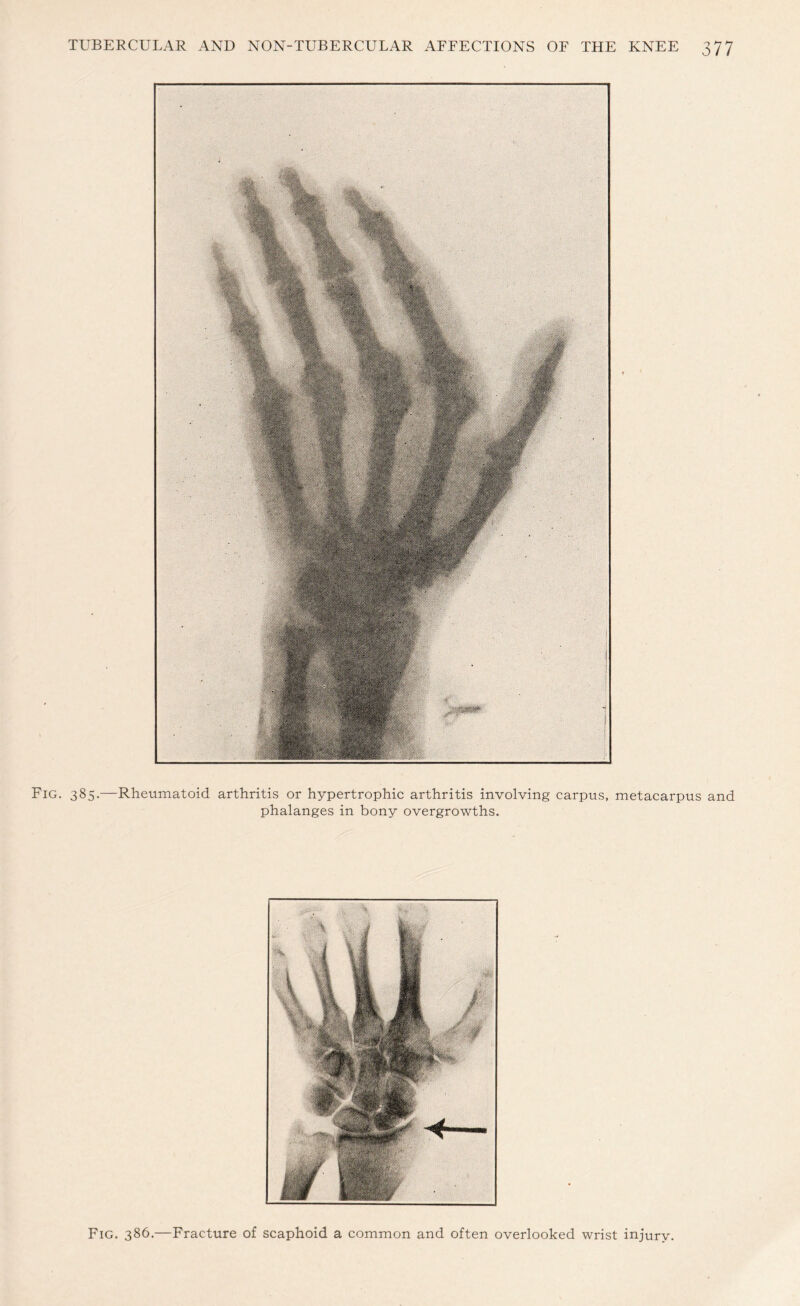 Fig. 385.—Rheumatoid arthritis or hypertrophic arthritis involving carpus, metacarpus and phalanges in bony overgrowths. Fig. 386.—Fracture of scaphoid a common and often overlooked wrist injury.