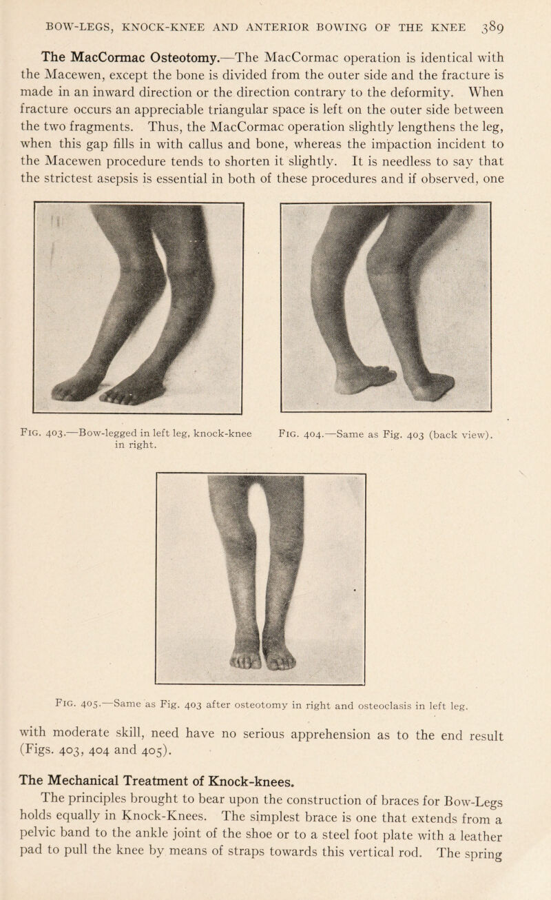 The MacCormac Osteotomy.—The MacCormac operation is identical with the Macewen, except the bone is divided from the outer side and the fracture is made in an inward direction or the direction contrary to the deformity. When fracture occurs an appreciable triangular space is left on the outer side between the two fragments. Thus, the MacCormac operation slightly lengthens the leg, wrhen this gap fills in with callus and bone, whereas the impaction incident to the Macewen procedure tends to shorten it slightly. It is needless to say that the strictest asepsis is essential in both of these procedures and if observed, one Fig. 403.—Bow-legged in left leg, knock-knee Fig. 404.—Same as Fig. 403 (back view). in right. Fig. 405. Same as Fig. 403 after osteotomy in right and osteoclasis in left leg. with moderate skill, need have no serious apprehension as to the end result (Figs. 403, 404 and 405). The Mechanical Treatment of Knock-knees. The principles brought to bear upon the construction of braces for Bow-Legs holds equally in Knock-Knees. The simplest brace is one that extends from a pelvic band to the ankle joint of the shoe or to a steel foot plate with a leather pad to pull the knee by means of straps towards this vertical rod. The spring