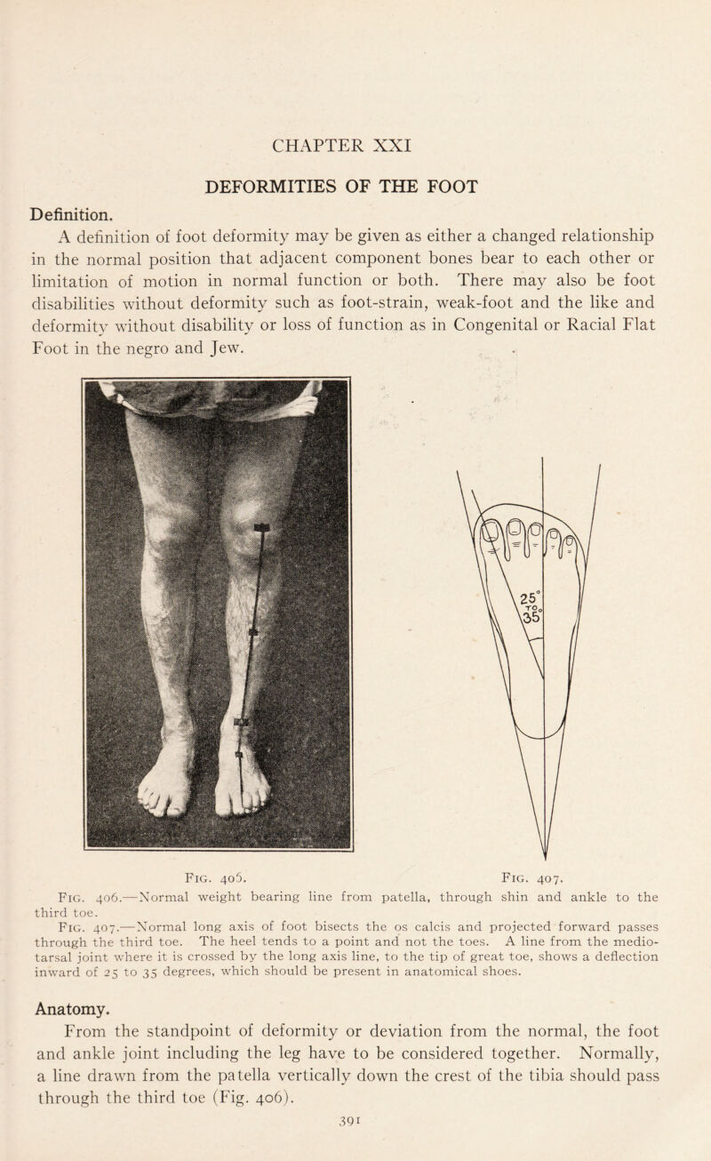 CHAPTER XXI DEFORMITIES OF THE FOOT Definition. A definition of foot deformity may be given as either a changed relationship in the normal position that adjacent component bones bear to each other or limitation of motion in normal function or both. There may also be foot disabilities without deformity such as foot-strain, weak-foot and the like and deformity without disability or loss of function as in Congenital or Racial Flat Foot in the negro and Jew. Fig. 4o5. Fig. 407. Fig. 406.—Normal weight bearing line from patella, through shin and ankle to the third toe. Fig. 407.—Normal long axis of foot bisects the os calcis and projected forward passes through the third toe. The heel tends to a point and not the toes. A line from the medio- tarsal joint where it is crossed by the long axis line, to the tip of great toe, shows a deflection inward of 25 to 35 degrees, which should be present in anatomical shoes. Anatomy. From the standpoint of deformity or deviation from the normal, the foot and ankle joint including the leg have to be considered together. Normally, a line drawn from the patella vertically down the crest of the tibia should pass through the third toe (Fig. 406).