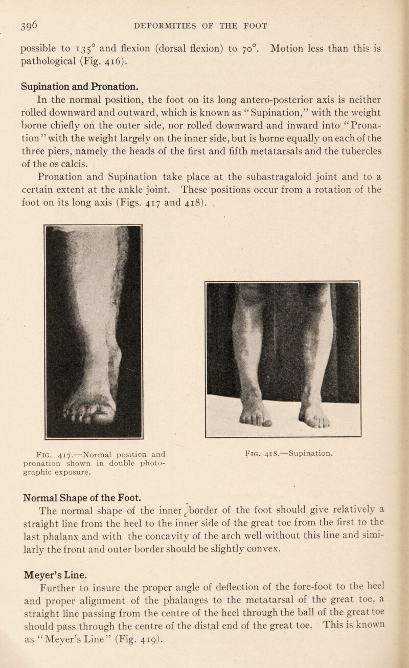 possible to 1350 and flexion (dorsal flexion) to 70°. Motion less than this is pathological (Fig. 416). Supination and Pronation. In the normal position, the foot on its long antero-posterior axis is neither rolled downward and outward, which is known as “ Supination,” with the weight borne chiefly on the outer side, nor rolled downward and inward into “ Prona¬ tion” with the weight largely on the inner side, but is borne equally on each of the three piers, namely the heads of the first and fifth metatarsals and the tubercles of the os calcis. Pronation and Supination take place at the subastragaloid joint and to a certain extent at the ankle joint. These positions occur from a rotation of the foot on its long axis (Figs. 417 and 418). . Fig. 417.—Normal position and pronation shown in double photo¬ graphic exposure. Normal Shape of the Foot. The normal shape of the inner ^border of the foot should give relatively a straight line from the heel to the inner side of the great toe from the first to the last phalanx and with the concavity of the arch well without this line and simi¬ larly the front and outer border should be slightly convex. Meyer’s Line. Further to insure the proper angle of deflection of the fore-foot to the heel and proper alignment of the phalanges to the metatarsal of the great toe, a straight line passing from the centre of the heel through the ball of the great toe should pass through the centre of the distal end of the great toe. This is known as “ Meyer’s Line ” (Fig. 419).