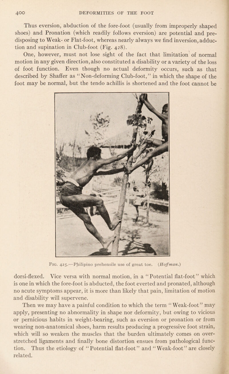 Thus eversion, abduction of the fore-foot (usually from improperly shaped shoes) and Pronation (which readily follows eversion) are potential and pre¬ disposing to Weak- or Flat-foot, whereas nearly always we find inversion, adduc¬ tion and supination in Club-foot (Fig. 428). One, however, must not lose sight of the fact that limitation of normal motion in any given direction, also constituted a disability or a variety of the loss of foot function. Even though no actual deformity occurs, such as that described by Shaffer as “Non-deforming Club-foot,” in which the shape of the foot may be normal, but the tendo achillis is shortened and the foot cannot be Fig. 425.—Philipino prehensile use of great toe. (Hoffman.) dorsi-flexed. Vice versa with normal motion, in a “Potential flat-foot” which is one in which the fore-foot is abducted, the foot everted and pronated, although no acute symptoms appear, it is more than likely that pain, limitation of motion and disability will supervene. Then we may have a painful condition to which the term “ Weak-foot” may apply, presenting no abnormality in shape nor deformity, but owing to vicious or pernicious habits in weight-bearing, such as eversion or pronation or from wearing non-anatomical shoes, harm results producing a progressive foot strain, which will so weaken the muscles that the burden ultimately comes on over¬ stretched ligaments and finally bone distortion ensues from pathological func¬ tion. Thus the etiology of “Potential flat-foot” and “Weak-foot” are closely related.