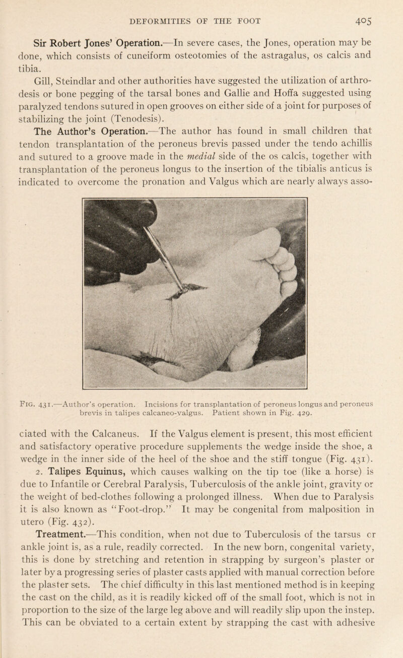 Sir Robert Jones’ Operation.—In severe cases, the Jones, operation may be done, which consists of cuneiform osteotomies of the astragalus, os calcis and tibia. Gill, Steindlar and other authorities have suggested the utilization of arthro¬ desis or bone pegging of the tarsal bones and Gallie and Hoffa suggested using paralyzed tendons sutured in open grooves on either side of a joint for purposes of stabilizing the joint (Tenodesis). The Author’s Operation.—The author has found in small children that tendon transplantation of the peroneus brevis passed under the tendo achillis and sutured to a groove made in the medial side of the os calcis, together with transplantation of the peroneus longus to the insertion of the tibialis anticus is indicated to overcome the pronation and Valgus which are nearly always asso- Fig. 431.—Author’s operation. Incisions for transplantation of peroneus longus and peroneus brevis in talipes calcaneo-valgus. Patient shown in Fig. 429. dated with the Calcaneus. If the Valgus element is present, this most efficient and satisfactory operative procedure supplements the wedge inside the shoe, a wedge in the inner side of the heel of the shoe and the stiff tongue (Fig. 431). 2. Talipes Equinus, which causes walking on the tip toe (like a horse) is due to Infantile or Cerebral Paralysis, Tuberculosis of the ankle joint, gravity or the weight of bed-clothes following a prolonged illness. When due to Paralysis it is also known as “ Foot-drop.” It may be congenital from malposition in utero (Fig. 432). Treatment.—This condition, when not due to Tuberculosis of the tarsus or ankle joint is, as a rule, readily corrected. In the new born, congenital variety, this is done by stretching and retention in strapping by surgeon’s plaster or later by a progressing series of plaster casts applied with manual correction before the plaster sets. The chief difficulty in this last mentioned method is in keeping the cast on the child, as it is readily kicked off of the small foot, which is not in proportion to the size of the large leg above and will readily slip upon the instep. This can be obviated to a certain extent by strapping the cast with adhesive