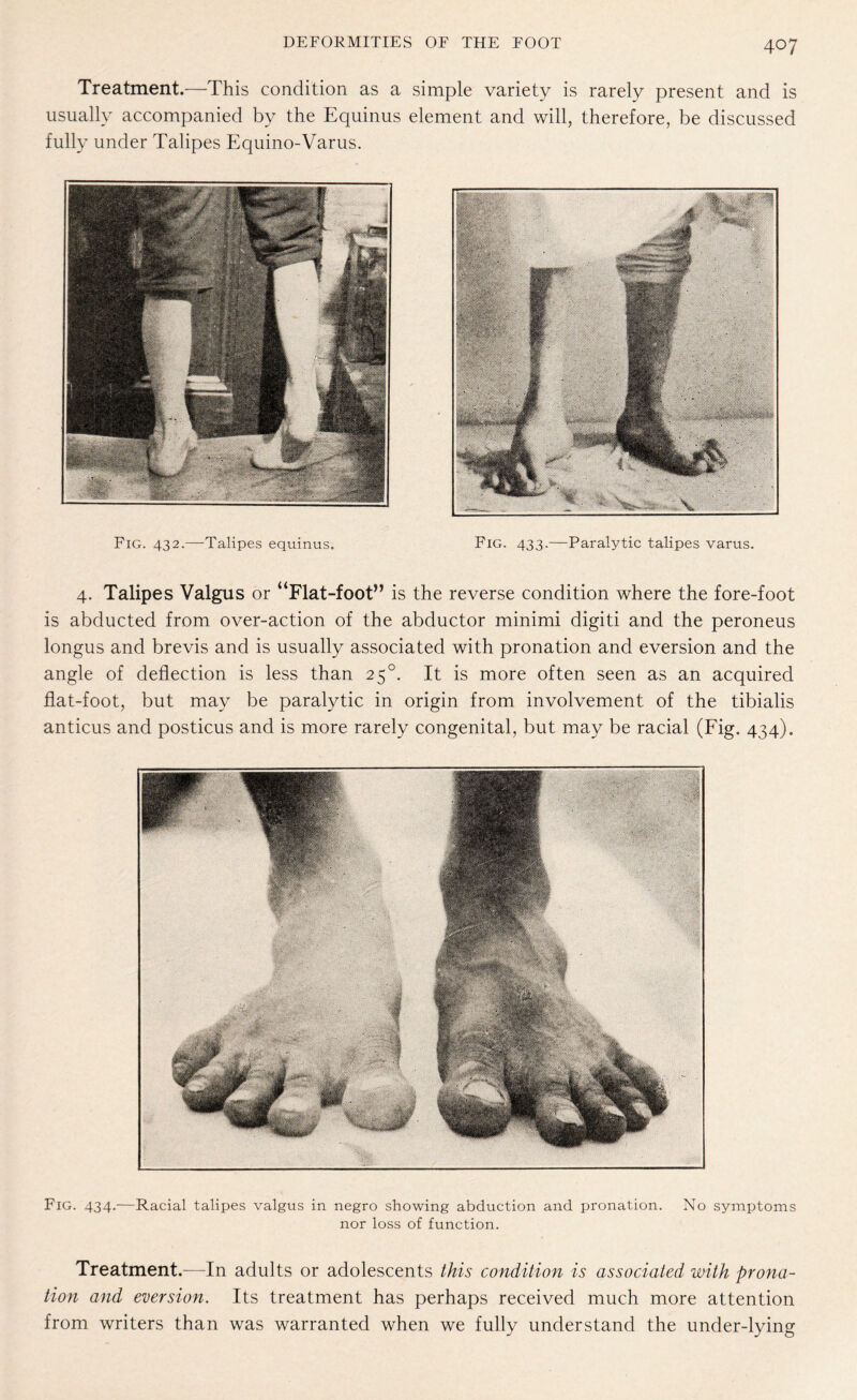 Treatment.—This condition as a simple variety is rarely present and is usually accompanied by the Equinus element and will, therefore, be discussed fully under Talipes Equino-Varus. Fig. 432.—Talipes equinus. Fig. 433.—Paralytic talipes varus. 4. Talipes Valgus or “Flat-foot” is the reverse condition where the fore-foot is abducted from over-action of the abductor minimi digiti and the peroneus longus and brevis and is usually associated with pronation and eversion and the angle of deflection is less than 250. It is more often seen as an acquired flat-foot, but may be paralytic in origin from involvement of the tibialis anticus and posticus and is more rarely congenital, but may be racial (Fig. 434). Fig. 434.—Racial talipes valgus in negro showing abduction and pronation. No symptoms nor loss of function. Treatment.—In adults or adolescents this condition is associated with prona¬ tion and eversion. Its treatment has perhaps received much more attention from writers than was warranted when we fully understand the under-lying