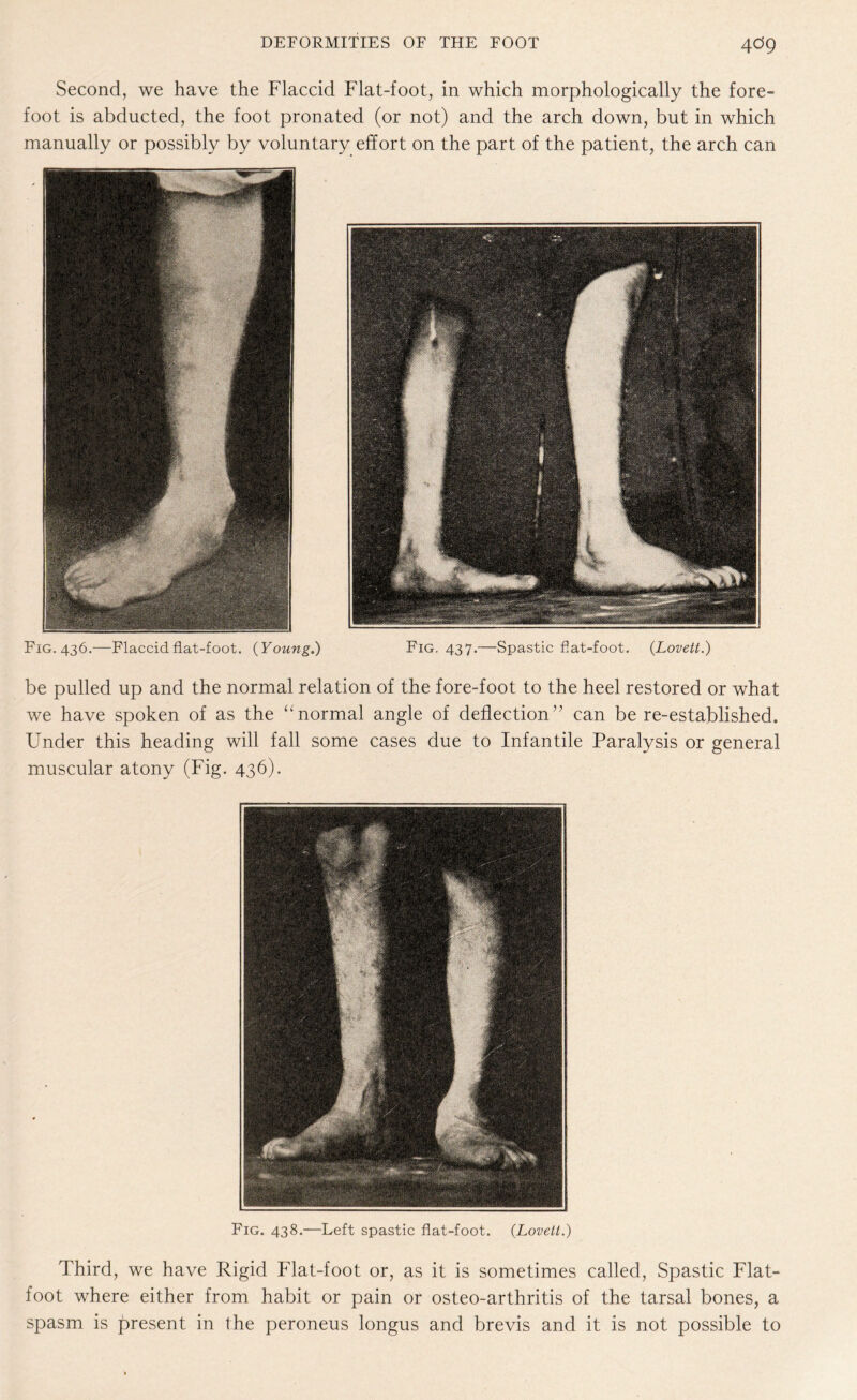 Second, we have the Flaccid Flat-foot, in which morphologically the fore¬ foot is abducted, the foot pronated (or not) and the arch down, but in which manually or possibly by voluntary effort on the part of the patient, the arch can Fig. 436.—Flaccid flat-foot. (Young.) Fig. 437.—Spastic flat-foot. {Lovett.) be pulled up and the normal relation of the fore-foot to the heel restored or what we have spoken of as the “normal angle of deflection” can be re-established. Under this heading will fall some cases due to Infantile Paralysis or general muscular atony (Fig. 436). Fig. 438.—Left spastic flat-foot. {Lovett.) Third, we have Rigid Flat-foot or, as it is sometimes called, Spastic Flat- foot where either from habit or pain or osteo-arthritis of the tarsal bones, a spasm is present in the peroneus longus and brevis and it is not possible to