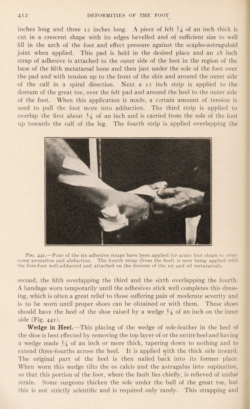 inches long and three 12 inches long. A piece of felt J4 of an inch thick is cut in a crescent shape with its edges bevelled and of sufficient size to well fill in the arch of the foot and effect pressure against the scapho-astraguloid joint when applied. This pad is held in the desired place and an 18 inch strap of adhesive is attached to the outer side of the foot in the region of the base of the fifth metatarsal bone and then just under the sole of the foot over the pad and with tension up to the front of the shin and around the outer side of the calf in a spiral direction. Next a 12 inch strip is applied to the dorsum of the great toe, over the felt pad and around the heel to the outer side of the foot. When this application is made, a certain amount of tension is used to pull the foot more into adduction. The third strip is applied to overlap the first about J4 of an inch and is carried from the sole of the foot up towards the calf of the leg. The fourth strip is applied overlapping the Fig. 441.—Four of the six adhesive straps have been applied for acute foot strain to over¬ come pronation and abduction. The fourth strap (from the heel) is seen being applied with the fore-foot well-adducted and attached on the dorsum of the ist and 2d metatarsals. second, the fifth overlapping the third and the sixth overlapping the fourth. A bandage worn temporarily until the adhesives stick well completes this dress¬ ing, which is often a great relief to those suffering pain of moderate severity and is to be worn until proper shoes can be obtained or with them. These shoes should have the heel of the shoe raised by a wedge J4 of an inch on the inner side (Fig. 441). Wedge in Heel.—This placing of the wedge of sole-leather in the heel of the shoe is best effected by removing the top layer of or the entire heel and having a wedge made 34 of an inch or more thick, tapering down to nothing and to extend three-fourths across the heel. It is applied with the thick side inward. The original part of the heel is then nailed back into its former place. When worn this wedge tilts the os calcis and the astragalus into supination, so that this portion of the foot, where the fault lies chiefly, is relieved of undue strain. Some surgeons thicken the sole under the ball of the great toe, but this is not strictly scientific and is required only rarely. This strapping and