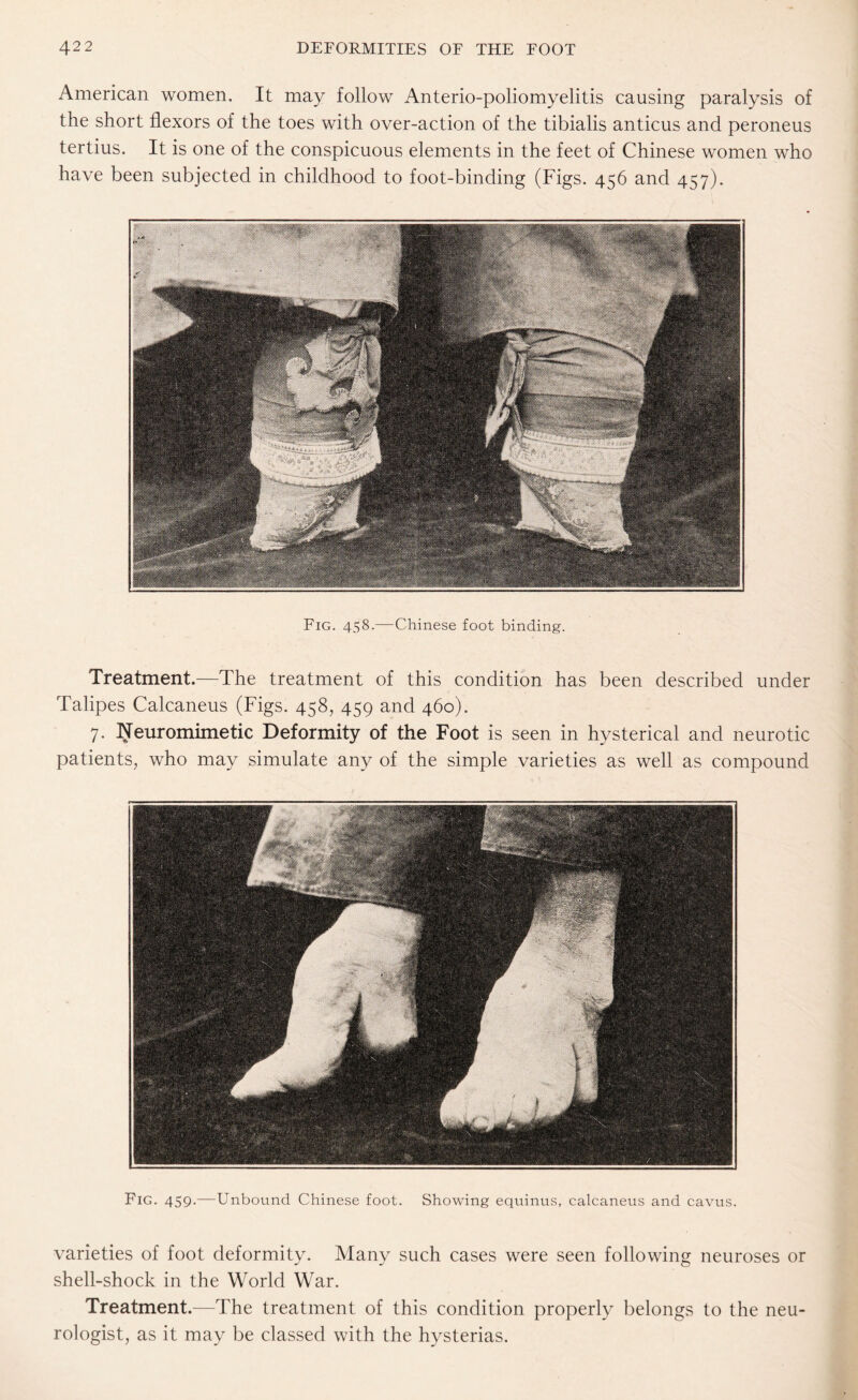 American women. It may follow Anterio-poliomyelitis causing paralysis of the short flexors of the toes with over-action of the tibialis anticus and peroneus tertius. It is one of the conspicuous elements in the feet of Chinese women who have been subjected in childhood to foot-binding (Figs. 456 and 457). Fig. 458.—Chinese foot binding. Treatment.—The treatment of this condition has been described under Talipes Calcaneus (Figs. 458, 459 and 460). 7. Neuromimetic Deformity of the Foot is seen in hysterical and neurotic patients, who may simulate any of the simple varieties as well as compound Fig. 459.—Unbound Chinese foot. Showing equinus, calcaneus and cavus. varieties of foot deformity. Many such cases were seen following neuroses or shell-shock in the World War. Treatment.—The treatment of this condition properly belongs to the neu¬ rologist, as it may be classed with the hysterias.