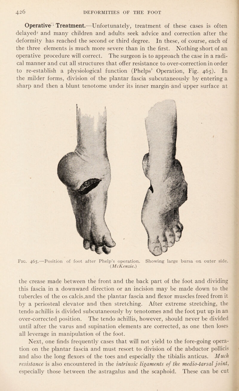 Operative ' Treatment.—Unfortunately, treatment of these cases is often delayed' and many children and adults seek advice and correction after the deformity has reached the second or third degree. In these, of course, each of the three elements is much more severe than in the first. Nothing short of an operative procedure will correct. The surgeon is to approach the case in a radi¬ cal manner and cut all structures that offer resistance to over-correction in order to re-establish a physiological function (Phelps’ Operation, Fig. 465). In the milder forms, division of the plantar fascia subcutaneously by entering a sharp and then a blunt tenotome under its inner margin and upper surface at Fig. 465.—Position of foot after Phelp’s operation. Showing large bursa on outer side. {McKenzie.) the crease made between the front and the back part of the foot and dividing this fascia in a downward direction or an incision may be made down to the tubercles of the os calcis.and the plantar fascia and flexor muscles freed from it by a periosteal elevator and then stretching. After extreme stretching, the tendo achillis is divided subcutaneously by tenotomes and the foot put up in an over-corrected position. The tendo achillis, however, should never be divided until after the varus and supination elements are corrected, as one then loses all leverage in manipulation of the foot. Next, one finds frequently cases that will not yield to the fore-going opera¬ tion on the plantar fascia and must resort to division of the abductor pollicis and also the long flexors of the toes and especially the tibialis anticus. Much resistance is also encountered in the intrinsic ligaments of the medio-tarsal joint, especially those between the astragalus and the scaphoid. These can be cut