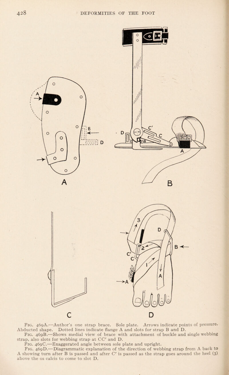 A C D Fig. 469A.—Author’s one strap brace. Sole plate. Arrows indicate points of pressure. Abducted shape. Dotted lines indicate flange A and slots for strap B and D. Fig. 469B.—Shows medial view of brace with attachment of buckle and single webbing strap, also slots for webbing strap at CC' and D. Fig. 469C.—Exaggerated angle between sole plate and upright. Fig. 469D.—Diagrammatic explanation of the direction of webbing strap from A back to A showing turn after B is passed and after C' is passed as the strap goes around the heel (3) above the os calcis to come to slot D.