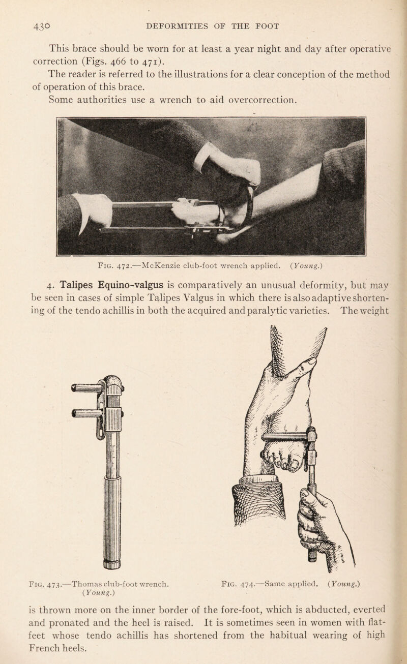 This brace should be worn for at least a year night and day after operative correction (Figs. 466 to 471). The reader is referred to the illustrations for a clear conception of the method of operation of this brace. Some authorities use a wrench to aid overcorrection. 4. Talipes Equino-valgus is comparatively an unusual deformity, but may be seen in cases of simple Talipes Valgus in which there is also adaptive shorten¬ ing of the tendo achillis in both the acquired and paralytic varieties. The weight Fig. 473.—Thomas club-foot wrench. Fig. 474.—Same applied. (Young.) (Young.) is thrown more on the inner border of the fore-foot, which is abducted, everted and pronated and the heel is raised. It is sometimes seen in women with flat- feet whose tendo achillis has shortened from the habitual wearing of high French heels.