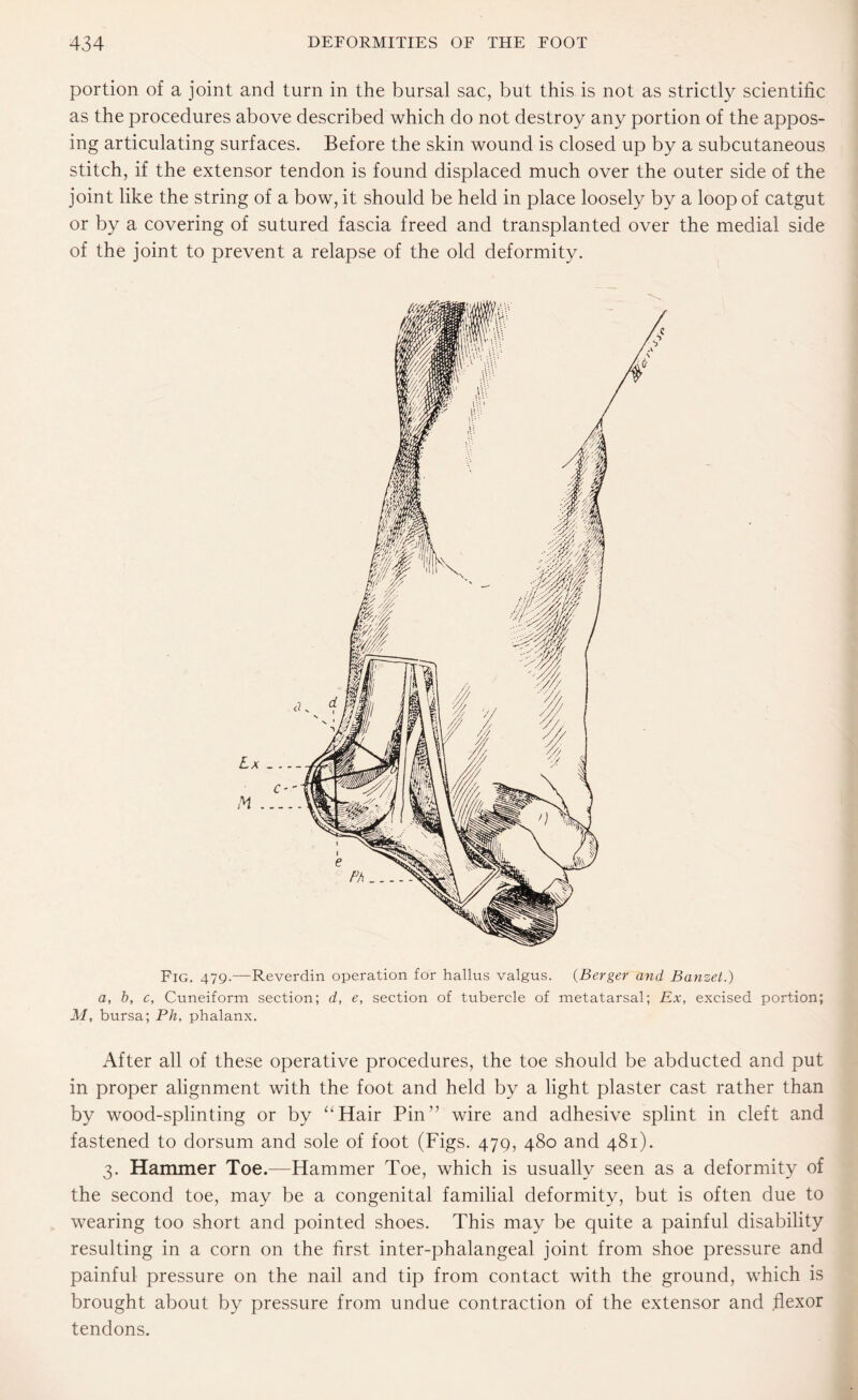 portion of a joint and turn in the bursal sac, but this is not as strictly scientific as the procedures above described which do not destroy any portion of the appos¬ ing articulating surfaces. Before the skin wound is closed up by a subcutaneous stitch, if the extensor tendon is found displaced much over the outer side of the joint like the string of a bow, it should be held in place loosely by a loop of catgut or by a covering of sutured fascia freed and transplanted over the medial side of the joint to prevent a relapse of the old deformity. Fig. 479.—Reverdin operation for hallus valgus. (Berger and Banzet.) a, b, c, Cuneiform section; d, e, section of tubercle of metatarsal; Ex, excised portion; M, bursa; Ph, phalanx. After all of these operative procedures, the toe should be abducted and put in proper alignment with the foot and held by a light plaster cast rather than by wood-splinting or by “Hair Pin” wire and adhesive splint in cleft and fastened to dorsum and sole of foot (Figs. 47Q, 480 and 481). 3. Hammer Toe.—Hammer Toe, which is usually seen as a deformity of the second toe, may be a congenital familial deformity, but is often due to wearing too short and pointed shoes. This may be quite a painful disability resulting in a corn on the first inter-phalangeal joint from shoe pressure and painful pressure on the nail and tip from contact with the ground, which is brought about by pressure from undue contraction of the extensor and flexor tendons.