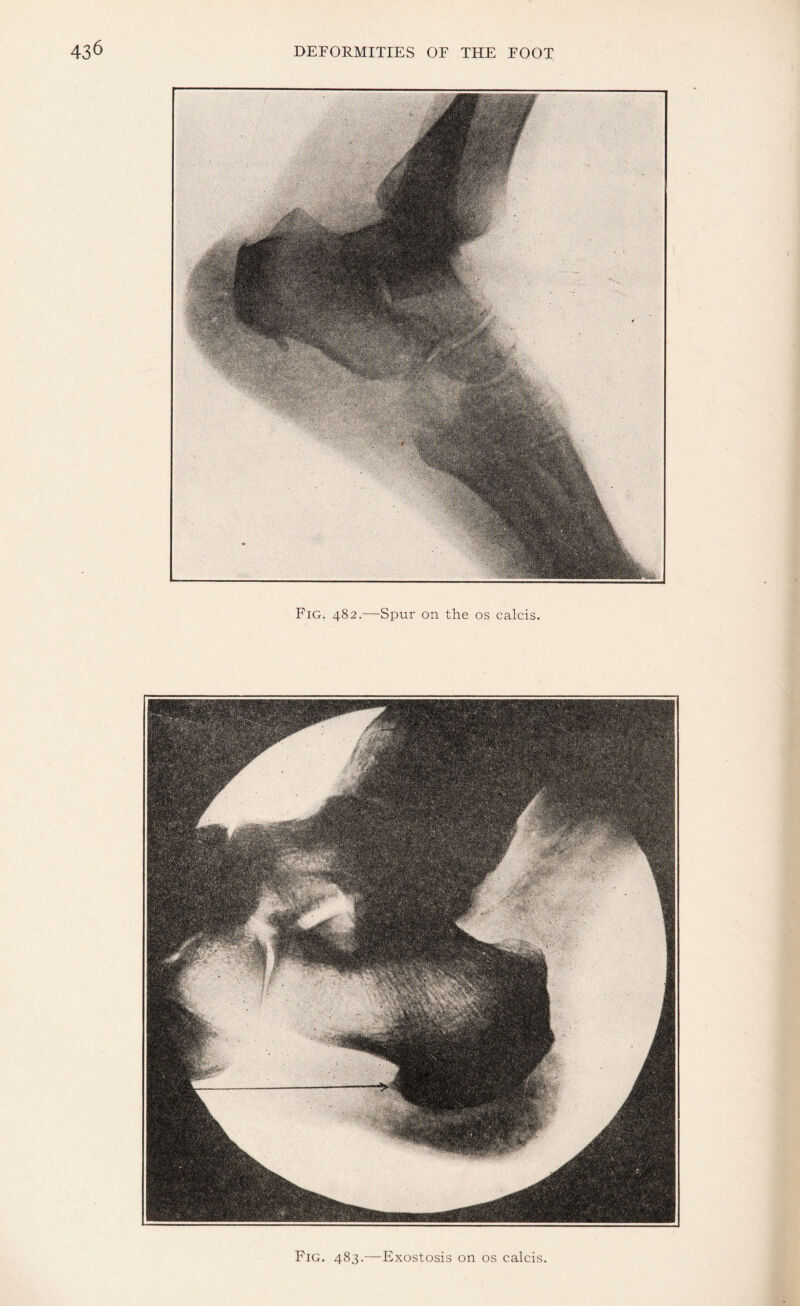 Fig. 483.—Exostosis on os calcis.