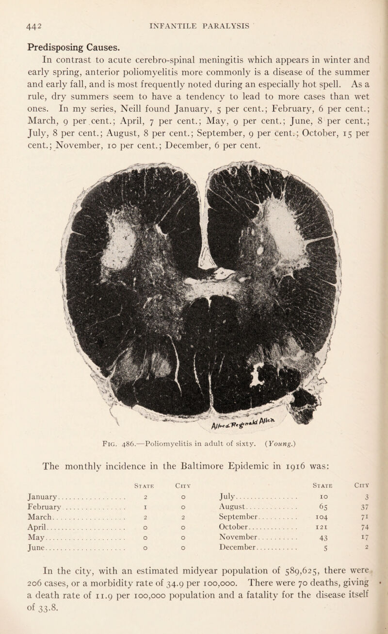 Predisposing Causes. In contrast to acute cerebro-spinal meningitis which appears in winter and early spring, anterior poliomyelitis more commonly is a disease of the summer and early fall, and is most frequently noted during an especially hot spell. As a rule, dry summers seem to have a tendency to lead to more cases than wet ones. In my series, Neill found January, 5 per cent.; February, 6 per cent.; March, 9 per cent.; April, 7 per cent.; May, 9 per cent.; June, 8 per cent.; July, 8 per cent.; August, 8 per cent.; September, 9 per cent.; October, 15 per cent.; November, 10 per cent.; December, 6 per cent. Fig. 486.—Poliomyelitis in adult of sixty. (Young.) The monthly incidence in the Baltimore Epidemic in 1916 was: State City State City January. . 2 0 July. 10 3 February. . 1 0 August. 65 37 March. . 2 2 September. 104 7i April. . 0 0 October. 121 74 May. . 0 0 November. 43 17 June. . 0 0 December. 5 2 In the city, with an estimated midyear population of 589,625, there were 206 cases, or a morbidity rate of 34.9 per 100,000. There were 70 deaths, giving a death rate of 11.9 per 100,000 population and a fatality for the disease itself of 33.8.