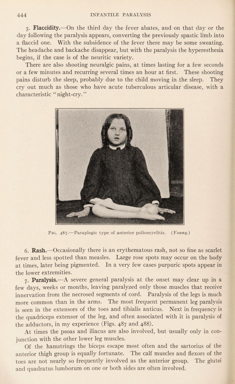 5. Flaccidity .—On the third day the fever abates, and on that day or the day following the paralysis appears, converting the previously spastic limb into a flaccid one. With the subsidence of the fever there may be some sweating. The headache and backache disappear, but with the paralysis the hyperesthesia begins, if the case is of the neuritic variety. There are also shooting neuralgic pains, at times lasting for a few seconds or a few minutes and recurring several times an hour at first. These shooting pains disturb the sleep, probably due to the child moving in the sleep. They cry out much as those who have acute tuberculous articular disease, with a characteristic “ night-cry. ” Fig. 487.—Paraplegic type of anterior poliomyelitis. (Young.) 6. Rash.—Occasionally there is an erythematous rash, not so fine as scarlet fever and less spotted than measles. Large rose spots may occur on the body at times, later being pigmented. In a very few cases purpuric spots appear in the lower extremities. 7. Paralysis.—A severe general paralysis at the onset may clear up in a few days, weeks or months, leaving paralyzed only those muscles that receive innervation from the necrosed segments of cord. Paralysis of the legs is much more common than in the arms. The most frequent permanent leg paralysis is seen in the extensors of the toes and tibialis anticus. Next in frequency is the quadriceps extensor of the leg, and often associated with it is paralysis of the adductors, in my experience (Figs. 487 and 488). At times the psoas and iliacus are also involved, but usually only in con¬ junction with the other lower leg muscles. Of the hamstrings the biceps escape most often and the sartorius of the anterior thigh group is equally fortunate. The calf muscles and flexors of the toes are not nearly so frequently involved as the anterior group. The glutei and quadratus lumborum on one or both sides are often involved.