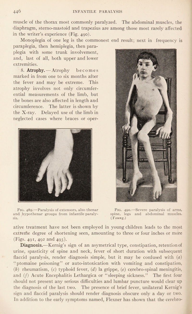 muscle of the thorax most commonly paralyzed. The abdominal muscles, the diaphragm, sterno-mastoid and trapezius are among those most rarely affected in the writer’s experience (Fig. 490). Monoplegia of one leg is the commonest end result; next in frequency is paraplegia, then hemiplegia, then para¬ plegia with some trunk involvement, and, last of all, both upper and lower extremities. 8. Atrophy. — Atrophy becomes marked in from one to six months after the fever and may be extreme. This atrophy involves not only circumfer¬ ential measurements of the limb, but the bones are also affected in length and circumference. The latter is shown by the X-ray. Delayed use of the limb in neglected cases where braces or oper- Fig. 489.—Paralysis of extensors, also thenar and hypothenar groups from infantile paraly¬ sis. Fig. 490.—Severe paralysis of arms, spine, legs and abdominal muscles. {Young.) ative treatment have not been employed in young children leads to the most extreme degree of shortening seen, amounting to three or four inches or more (Figs. 491, 492 and 493). Diagnosis.—Kernig’s sign of an asymetrical type, constipation, retention of urine, spasticity of spine and neck, fever of short duration with subsequent flaccid paralysis, render diagnosis simple, but it may be confused with (a) ‘‘ptomaine poisoning” or auto-intoxication with vomiting and constipation, (b) rheumatism, (c) typhoid fever, (d) la grippe, (e) cerebro-spinal meningitis, and (/) Acute Encephalitis Lethargica or “sleeping sickness.” The first four should not present any serious difficulties and lumbar puncture would clear up the diagnosis of the last two. The presence of brief fever, unilateral Kernig’s sign and flaccid paralysis should render diagnosis obscure only a day or two. In addition to the early symptoms named, Flexner has shown that the cerebro-