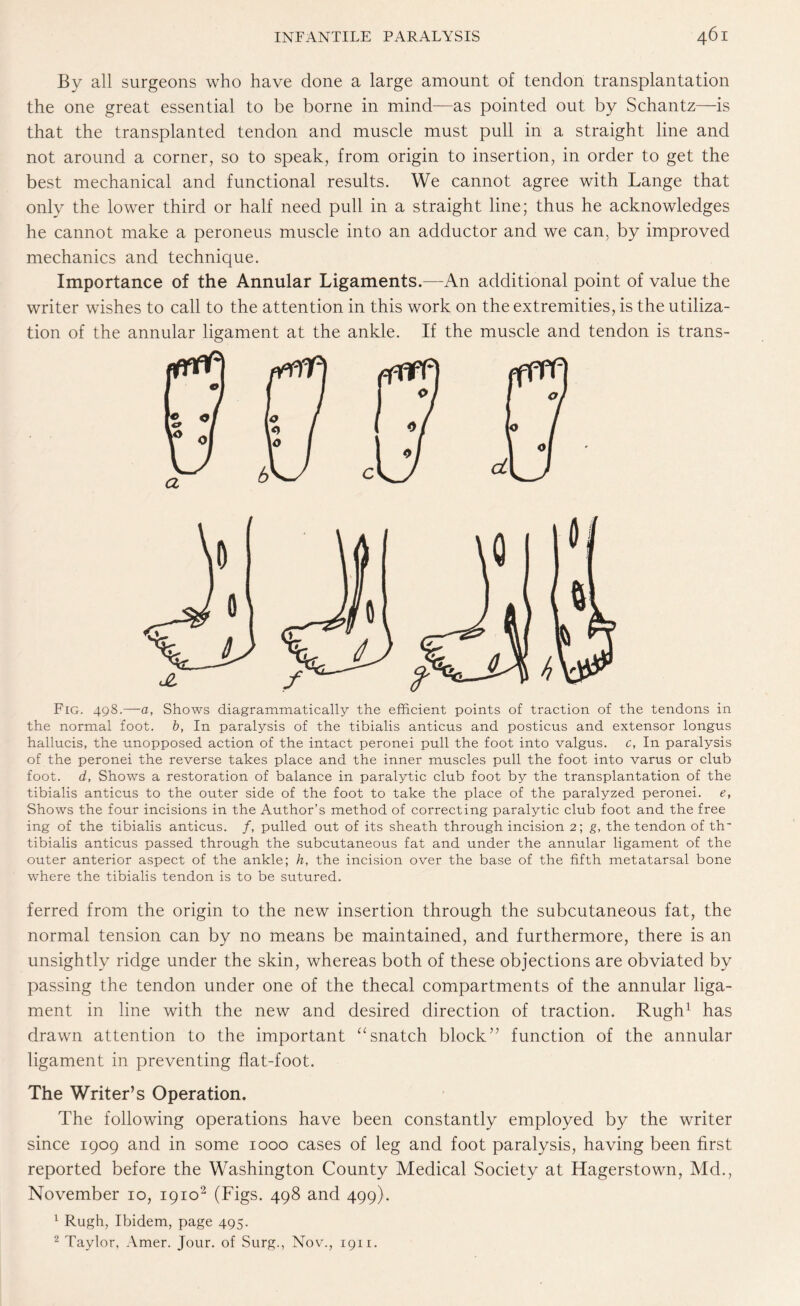 By all surgeons who have done a large amount of tendon transplantation the one great essential to be borne in mind—as pointed out by Schantz—is that the transplanted tendon and muscle must pull in a straight line and not around a corner, so to speak, from origin to insertion, in order to get the best mechanical and functional results. We cannot agree with Lange that only the lower third or half need pull in a straight line; thus he acknowledges he cannot make a peroneus muscle into an adductor and we can. by improved mechanics and technique. Importance of the Annular Ligaments.—An additional point of value the writer wishes to call to the attention in this work on the extremities, is the utiliza¬ tion of the annular ligament at the ankle. If the muscle and tendon is trans- Fig. 498.—a, Shows diagrammatically the efficient points of traction of the tendons in the normal foot, b, In paralysis of the tibialis anticus and posticus and extensor longus hallucis, the unopposed action of the intact peronei pull the foot into valgus, c, In paralysis of the peronei the reverse takes place and the inner muscles pull the foot into varus or club foot, d, Shows a restoration of balance in paralytic club foot by the transplantation of the tibialis anticus to the outer side of the foot to take the place of the paralyzed peronei. e, Shows the four incisions in the Author’s method of correcting paralytic club foot and the free ing of the tibialis anticus. /, pulled out of its sheath through incision 2; g, the tendon of th~ tibialis anticus passed through the subcutaneous fat and under the annular ligament of the outer anterior aspect of the ankle; h, the incision over the base of the fifth metatarsal bone where the tibialis tendon is to be sutured. ferred from the origin to the new insertion through the subcutaneous fat, the normal tension can by no means be maintained, and furthermore, there is an unsightly ridge under the skin, whereas both of these objections are obviated by passing the tendon under one of the thecal compartments of the annular liga¬ ment in line with the new and desired direction of traction. Rugh1 has drawn attention to the important “snatch block” function of the annular ligament in preventing flat-foot. The Writer’s Operation. The following operations have been constantly employed by the writer since 1909 and in some 1000 cases of leg and foot paralysis, having been first reported before the Washington County Medical Society at Hagerstown, Md., November io, 19102 (Figs. 498 and 499). 1 Rugh, Ibidem, page 495. 2 Taylor, Amer. Jour, of Surg., Nov., 1911.