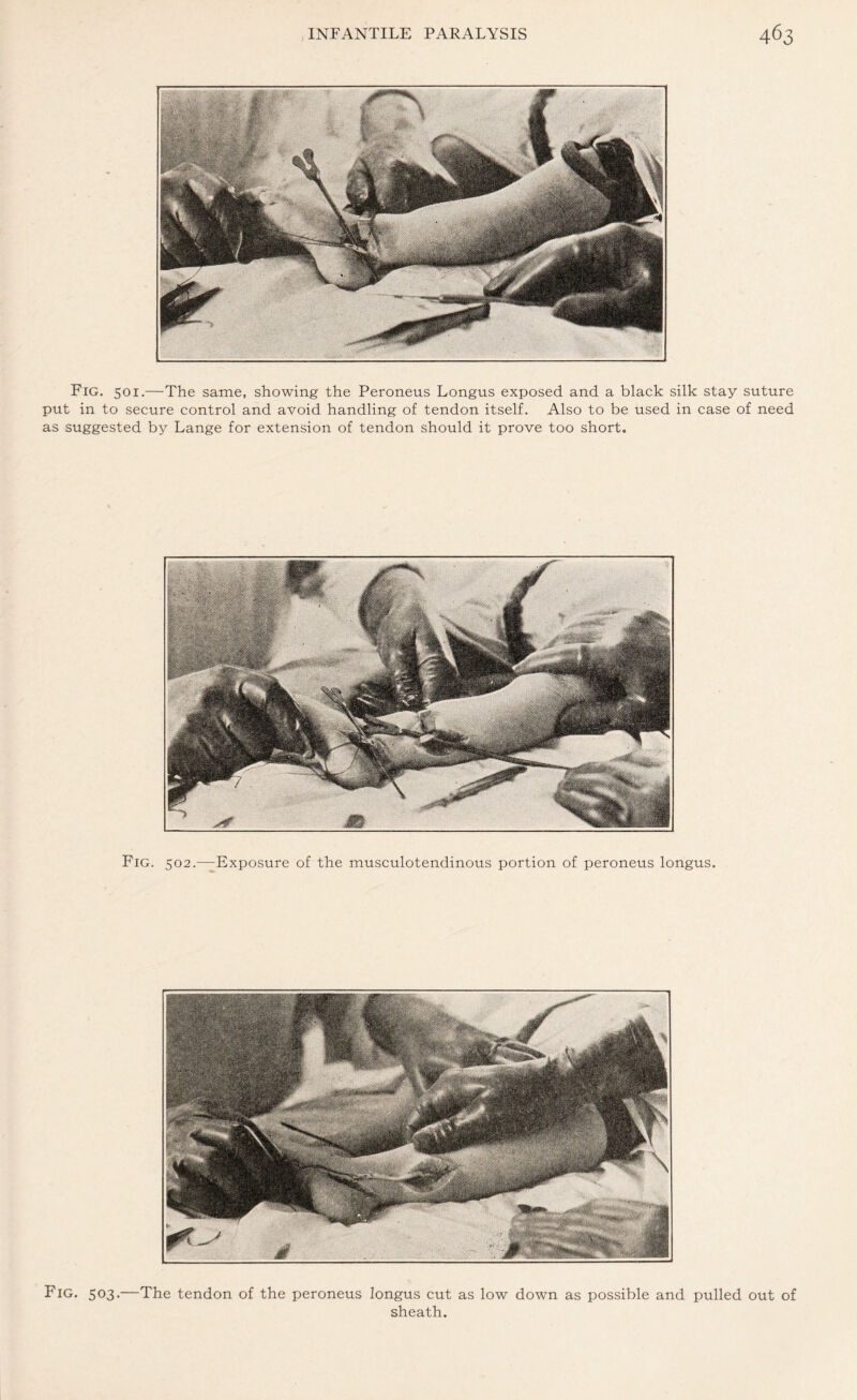 Fig. 501.—The same, showing the Peroneus Longus exposed and a black silk stay suture put in to secure control and avoid handling of tendon itself. Also to be used in case of need as suggested by Lange for extension of tendon should it prove too short. Fig. 502.—Exposure of the musculotendinous portion of peroneus longus. Fig. 503.—The tendon of the peroneus longus cut as low down as possible and pulled out of sheath.