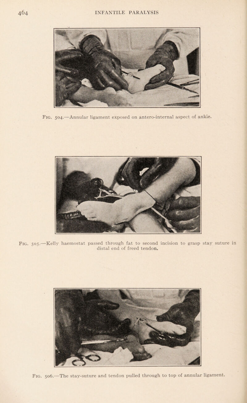 Fig. 504.—Annular ligament exposed on antero-internal aspect of ankle. Fig. 505.—Kelly haemostat passed through fat to second incision to grasp stay suture in distal end of freed tendon. Fig. 506.—The stay-suture and tendon pulled through to top of annular ligament.