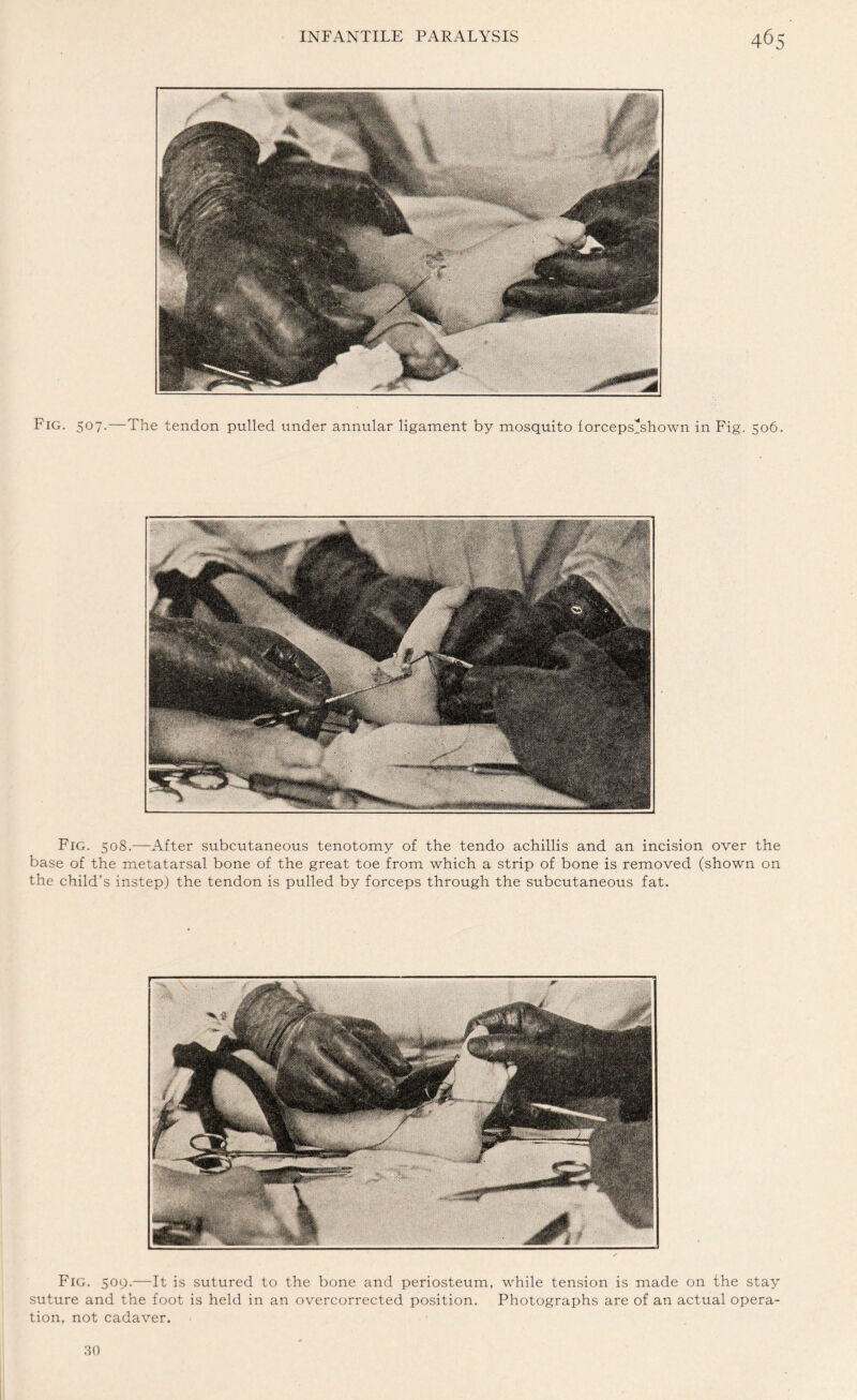 Fig. 508.—After subcutaneous tenotomy of the tendo achillis and an incision over the base of the metatarsal bone of the great toe from which a strip of bone is removed (shown on the child’s instep) the tendon is pulled by forceps through the subcutaneous fat. Fig. 509.—It is sutured to the bone and periosteum, while tension is made on the stay suture and the foot is held in an overcorrected position. Photographs are of an actual opera¬ tion, not cadaver. 30