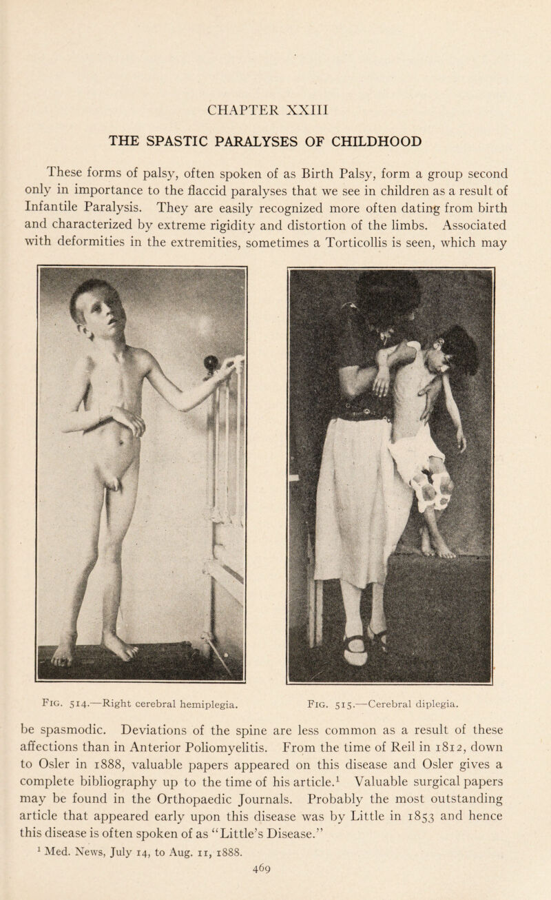 CHAPTER XXIII THE SPASTIC PARALYSES OF CHILDHOOD These forms of palsy, often spoken of as Birth Palsy, form a group second only in importance to the flaccid paralyses that we see in children as a result of Infantile Paralysis. They are easily recognized more often dating from birth and characterized by extreme rigidity and distortion of the limbs. Associated with deformities in the extremities, sometimes a Torticollis is seen, which may Fig. 514.—Right cerebral hemiplegia. Fig. 515.-—-Cerebral diplegia. be spasmodic. Deviations of the spine are less common as a result of these affections than in Anterior Poliomyelitis. From the time of Reil in 1812, down to Osier in 1888, valuable papers appeared on this disease and Osier gives a complete bibliography up to the time of his article.1 Valuable surgical papers may be found in the Orthopaedic Journals. Probably the most outstanding article that appeared early upon this disease was by Little in 1853 and hence this disease is often spoken of as “Little’s Disease.” 1 Med. News, July 14, to Aug. 11, 1888.