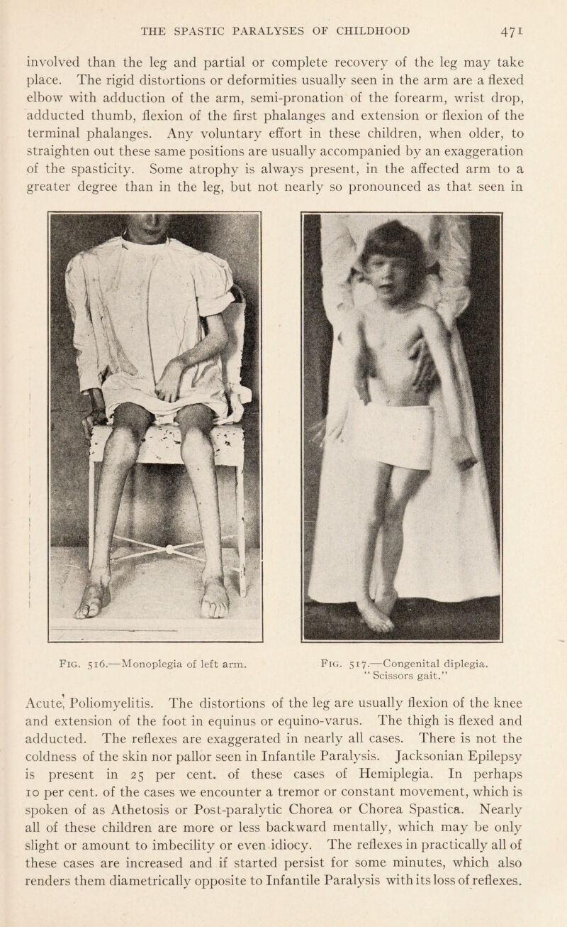 involved than the leg and partial or complete recovery of the leg may take place. The rigid distortions or deformities usually seen in the arm are a flexed elbow with adduction of the arm, semi-pronation of the forearm, wrist drop, adducted thumb, flexion of the first phalanges and extension or flexion of the terminal phalanges. Any voluntary effort in these children, when older, to straighten out these same positions are usually accompanied by an exaggeration of the spasticity. Some atrophy is always present, in the affected arm to a greater degree than in the leg, but not nearly so pronounced as that seen in i Fig. 516.—Monoplegia of left arm. Fig. 517.—Congenital diplegia. “ Scissors gait.” Acute, Poliomyelitis. The distortions of the leg are usually flexion of the knee and extension of the foot in equinus or equino-varus. The thigh is flexed and adducted. The reflexes are exaggerated in nearly all cases. There is not the coldness of the skin nor pallor seen in Infantile Paralysis. Jacksonian Epilepsy is present in 25 per cent, of these cases of Hemiplegia. In perhaps 10 per cent, of the cases we encounter a tremor or constant movement, which is spoken of as Athetosis or Post-paralytic Chorea or Chorea Spastica. Nearly all of these children are more or less backward mentally, which may be only slight or amount to imbecility or even idiocy. The reflexes in practically all of these cases are increased and if started persist for some minutes, which also renders them diametrically opposite to Infantile Paralysis with its loss of reflexes.