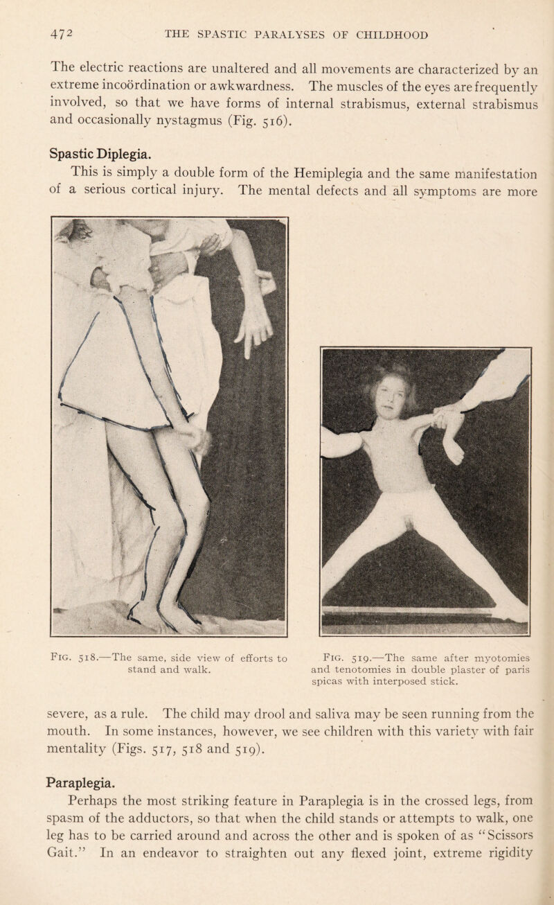 The electric reactions are unaltered and all movements are characterized by an extreme incoordination or awkwardness. The muscles of the eyes are frequently involved, so that we have forms of internal strabismus, external strabismus and occasionally nystagmus (Fig. 516). Spastic Diplegia. This is simply a double form of the Hemiplegia and the same manifestation of a serious cortical injury. The mental defects and all symptoms are more Fig. 518.—The same, side view of efforts to stand and walk. Fig. 519.—The same after myotomies and tenotomies in double plaster of paris spicas with interposed stick. severe, as a rule. The child may drool and saliva may be seen running from the mouth. In some instances, however, we see children with this variety with fair mentality (Figs. 517, 518 and 519). Paraplegia. Perhaps the most striking feature in Paraplegia is in the crossed legs, from spasm of the adductors, so that when the child stands or attempts to walk, one leg has to be carried around and across the other and is spoken of as “ Scissors Gait.1’ In an endeavor to straighten out any flexed joint, extreme rigidity