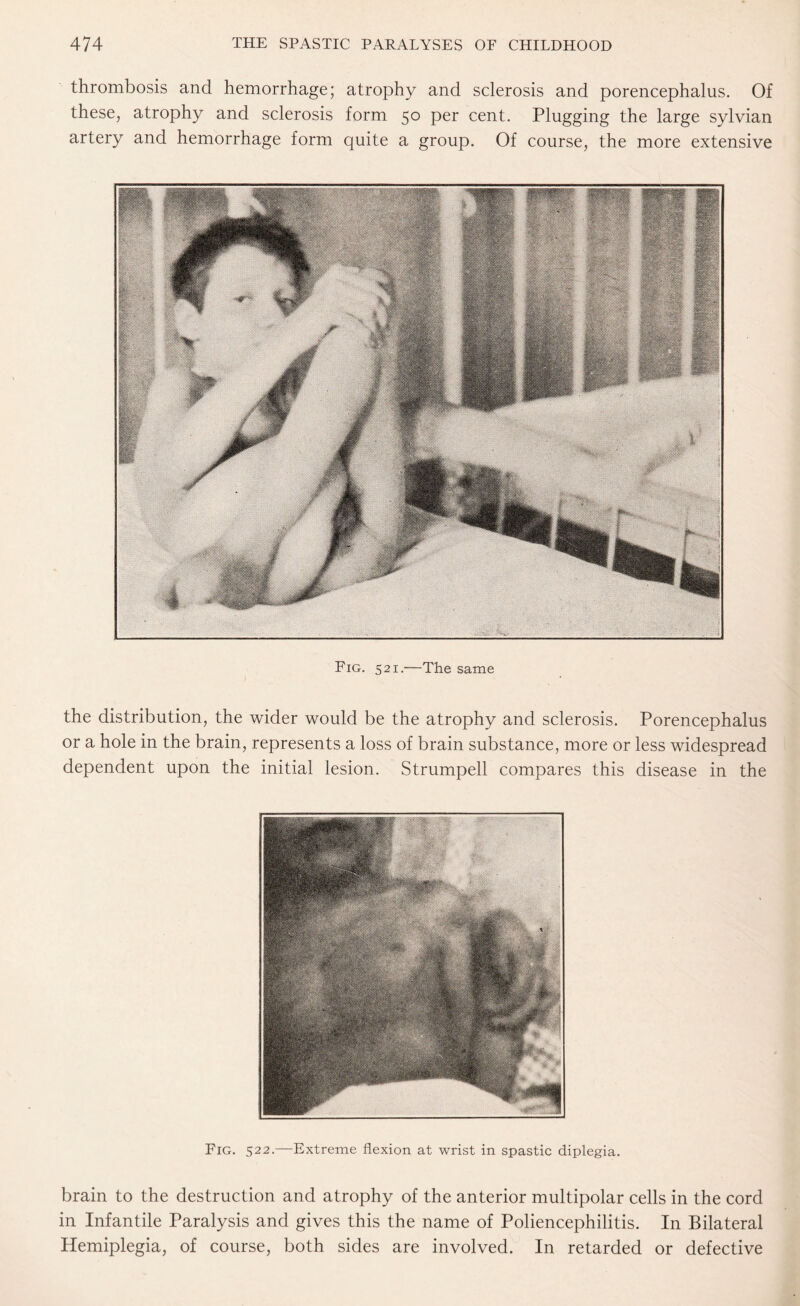 thrombosis and hemorrhage; atrophy and sclerosis and porencephalus. Of these, atrophy and sclerosis form 50 per cent. Plugging the large sylvian artery and hemorrhage form quite a group. Of course, the more extensive Fig. 521.—The same the distribution, the wider would be the atrophy and sclerosis. Porencephalus or a hole in the brain, represents a loss of brain substance, more or less widespread dependent upon the initial lesion. Strumpell compares this disease in the Fig. 522.—Extreme flexion at wrist in spastic diplegia. brain to the destruction and atrophy of the anterior multipolar cells in the cord in Infantile Paralysis and gives this the name of Poliencephilitis. In Bilateral Hemiplegia, of course, both sides are involved. In retarded or defective