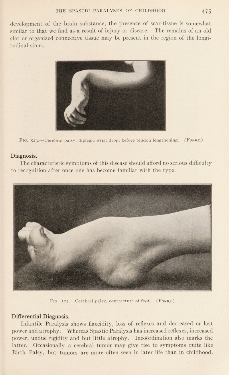 development of the brain substance, the presence of scar-tissue is somewhat similar to that we find as a result of injury or disease. The remains of an old clot or organized connective tissue may be present in the region of the longi¬ tudinal sinus. Fig. 523.—Cerebral palsy, diplegic wrist drop, before tendon lengthening. (Young.) Diagnosis. The characteristic symptoms of this disease should afford no serious difficulty to recognition after once one has become familiar with the type. Fig. 524.—Cerebral palsy, contracture of foot. (Young.) Differential Diagnosis. Infantile Paralysis shows flaccidity, loss of reflexes and decreased or lost power and atrophy. Whereas Spastic Paralysis has increased reflexes, increased power, undue rigidity and but little atrophy. Incoordination also marks the latter. Occasionally a cerebral tumor may give rise to symptoms quite like Birth Palsy, but tumors are more often seen in later life than in childhood.