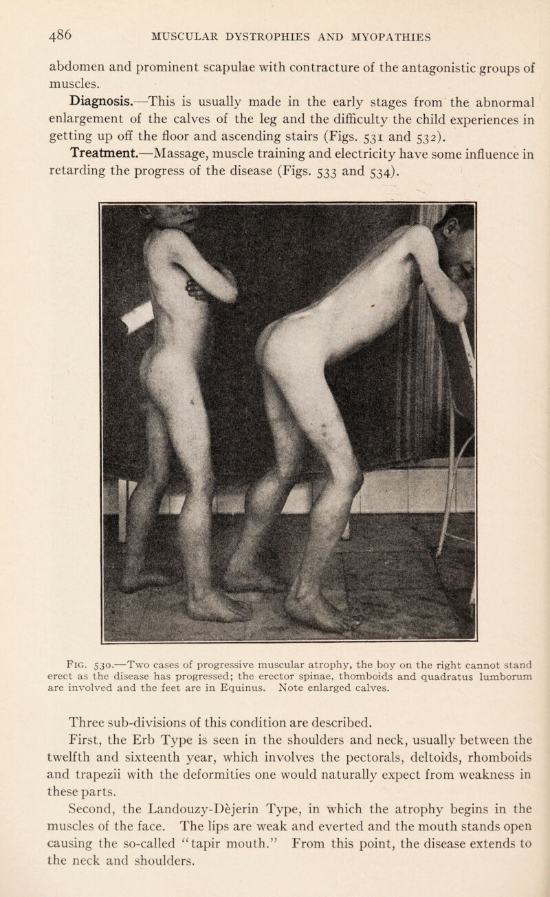 abdomen and prominent scapulae with contracture of the antagonistic groups of muscles. Diagnosis.—This is usually made in the early stages from the abnormal enlargement of the calves of the leg and the difficulty the child experiences in getting up off the floor and ascending stairs (Figs. 531 and 532). Treatment.—Massage, muscle training and electricity have some influence in retarding the progress of the disease (Figs. 533 and 534). Fig. 530.—Two cases of progressive muscular atrophy, the boy on the right cannot stand erect as the disease has progressed; the erector spinae, thomboids and quadratus lumborum are involved and the feet are in Equinus. Note enlarged calves. Three sub-divisions of this condition are described. First, the Erb Type is seen in the shoulders and neck, usually between the twelfth and sixteenth year, which involves the pectorals, deltoids, rhomboids and trapezii with the deformities one would naturally expect from weakness in these parts. Second, the Landouzy-Dejerin Type, in which the atrophy begins in the muscles of the face. The lips are weak and everted and the mouth stands open causing the so-called “tapir mouth.” From this point, the disease extends to the neck and shoulders.