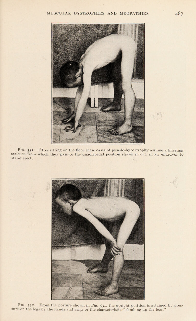 •iV Fig. 531.—After sitting on the floor these cases of psuedo-hypertrophy assume a kneeling attitude from which they pass to the quadripedal position shown in cut, in an endeavor to stand erect. Fig. 532.—From the posture shown in Fig. 531, the upright position is attained by pres¬ sure on the legs by the hands and arms or the characteristic “climbing up the legs.”