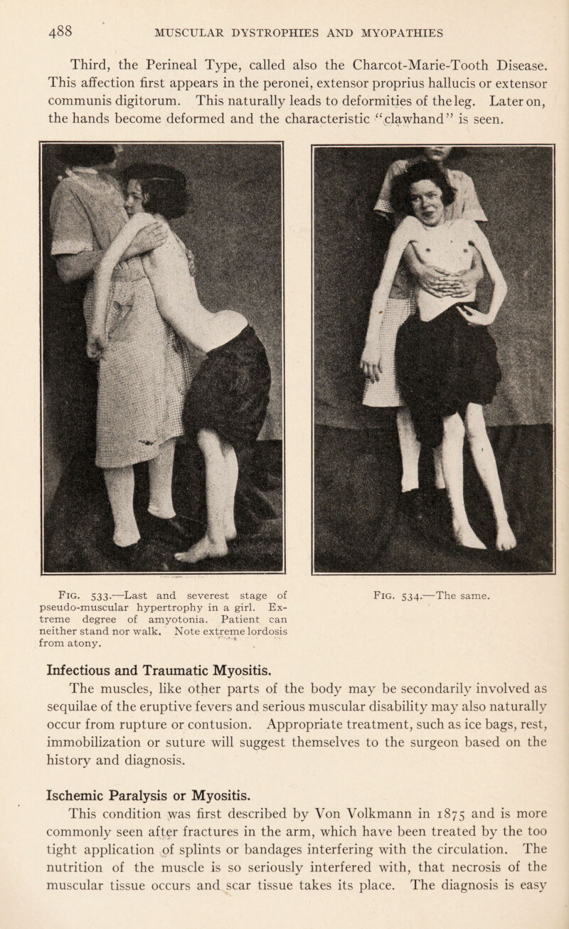 Third, the Perineal Type, called also the Charcot-Marie-Tooth Disease. This affection first appears in the peronei, extensor proprius hallucis or extensor communis digitorum. This naturally leads to deformities of the leg. Later on, the hands become deformed and the characteristic “clawhand” is seen. Fig. 533.—Last and severest stage of Fig. 534.—The same, pseudo-muscular hypertrophy in a girl. Ex¬ treme degree of amyotonia. Patient can neither stand nor walk. Note extreme lordosis from atony. Infectious and Traumatic Myositis. The muscles, like other parts of the body may be secondarily involved as sequilae of the eruptive fevers and serious muscular disability may also naturally occur from rupture or contusion. Appropriate treatment, such as ice bags, rest, immobilization or suture will suggest themselves to the surgeon based on the history and diagnosis. Ischemic Paralysis or Myositis. This condition was first described by Von Volkmann in 1875 and is more commonly seen after fractures in the arm, which have been treated by the too tight application of splints or bandages interfering with the circulation. The nutrition of the muscle is so seriously interfered with, that necrosis of the muscular tissue occurs and scar tissue takes its place. The diagnosis is easy