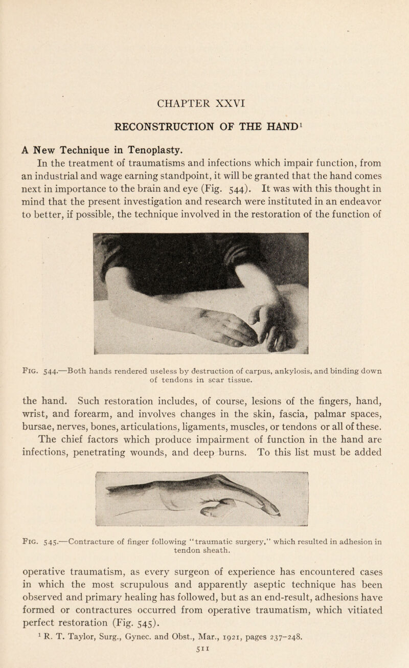 CHAPTER XXVI RECONSTRUCTION OF THE HAND1 A New Technique in Tenoplasty. In the treatment of traumatisms and infections which impair function, from an industrial and wage earning standpoint, it will be granted that the hand comes next in importance to the brain and eye (Fig. 544). It was with this thought in mind that the present investigation and research were instituted in an endeavor to better, if possible, the technique involved in the restoration of the function of Fig. 544.—Both, hands rendered useless by destruction of carpus, ankylosis, and binding down of tendons in scar tissue. the hand. Such restoration includes, of course, lesions of the fingers, hand, wrist, and forearm, and involves changes in the skin, fascia, palmar spaces, bursae, nerves, bones, articulations, ligaments, muscles, or tendons or all of these. The chief factors which produce impairment of function in the hand are infections, penetrating wounds, and deep burns. To this list must be added Fig. 545.—Contracture of finger following “traumatic surgery,” which resulted in adhesion in tendon sheath. operative traumatism, as every surgeon of experience has encountered cases in which the most scrupulous and apparently aseptic technique has been observed and primary healing has followed, but as an end-result, adhesions have formed or contractures occurred from operative traumatism, which vitiated perfect restoration (Fig. 545). 1 R. T. Taylor, Surg., Gynec. and Obst., Mar., 1921, pages 237-248.