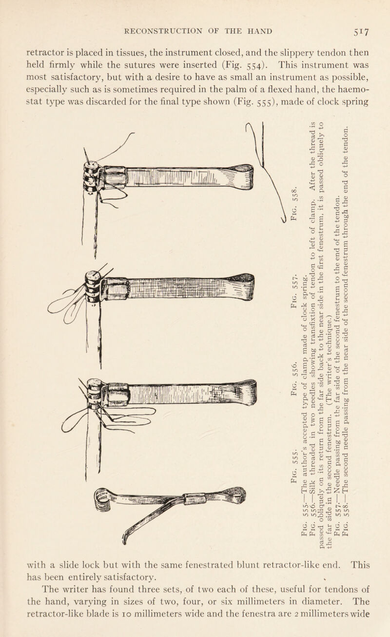 retractor is placed in tissues, the instrument closed, and the slippery tendon then held firmly while the sutures were inserted (Fig. 554). This instrument was most satisfactory, but with a desire to have as small an instrument as possible, especially such as is sometimes required in the palm of a flexed hand, the haemo- stat type was discarded for the final type shown (Fig. 555), made of clock spring Pi o ft £ CD -ft CD ft OO lO o ft ft t'- be to fH lO • ft • ft O w pa ft M o O r I o O <D ft cS ft o a (ft ft ^ <D P I ~l < a in • • T—I ft ft 40 C d ft o S - g O 4^> in 4^ 0 tftft rH ^ D tM -2 441 ^ in G ft CJft O ft 2 £ ft* d 44 +* PI —1 O <D ~ w to 6 (ft o O CD CD ft ft -ft ft <D -ft ft (D CD O d ft <D <D Pi . W to V to O to pp s I CD ft! H ft ft Pi CD d £ I4 ft (D -ft P <D O fift O .ft (D PS ft -ft w 0) ID ft G +3 cd -2 ft ft P< 2 O ft o ft CD IP in ft d CD Pi CD -ft X ft m d ft U 4^> ^ O bo £h m •th *74 t % ft'0 W CD ft w ‘53 11 D . D ^ft a ft ID o 12 D W D o w D ft d D D ft D ft -ft D 44 ft o ft ft d ft D ft £ a 44 o ft .a ^ pi ft p D ft H ft D ft « d ft D ft W ft ft -ft 44 Pi _ O • tH . CO ft G CD ^ ft a CO P ♦H *h *+-* ,t2 50 d .a rj W ft W s a a ft O D T-3 V-h ' I w 'ft-1 Uj <u . . 0 ^ 0 a D ft P5 144 10 , Tft to ft a c« p a & ° O o O D O D n4 w in ft D D D (U ft ft £ H lap too D1 to toft « to lO,Q ft O W o o ft ft ft ft ft D in in d ft -p ft d tft D ft r~~ 00 to to to to 0 o’ ►—I t—» ft ft with a slide lock but with the same fenestrated blunt retractor-like end. This has been entirely satisfactory. The writer has found three sets, of two each of these, useful for tendons of the hand, varying in sizes of two, four, or six millimeters in diameter. The