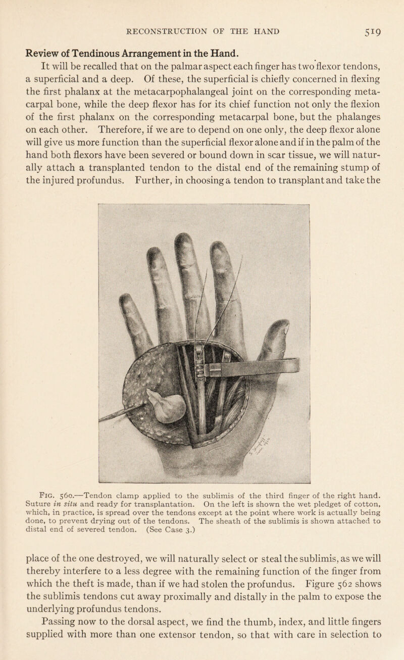 Review of Tendinous Arrangement in the Hand. It will be recalled that on the palmar aspect each finger has two flexor tendons, a superficial and a deep. Of these, the superficial is chiefly concerned in flexing the first phalanx at the metacarpophalangeal joint on the corresponding meta¬ carpal bone, while the deep flexor has for its chief function not only the flexion of the first phalanx on the corresponding metacarpal bone, but the phalanges on each other. Therefore, if we are to depend on one only, the deep flexor alone will give us more function than the superficial flexor alone and if in the palm of the hand both flexors have been severed or bound down in scar tissue, we will natur¬ ally attach a transplanted tendon to the distal end of the remaining stump of the injured profundus. Further, in choosing a tendon to transplant and take the Fig. 560.—Tendon clamp applied to the sublimis of the third finger of the right hand. Suture in situ and ready for transplantation. On the left is shown the wet pledget of cotton, which, in practice, is spread over the tendons except at the point where work is actually being done, to prevent drying out of the tendons. The sheath of the sublimis is shown attached to distal end of severed tendon. (See Case 3.) place of the one destroyed, we will naturally select or steal the sublimis, as we will thereby interfere to a less degree with the remaining function of the finger from which the theft is made, than if we had stolen the profundus. Figure 562 shows the sublimis tendons cut away proximally and distally in the palm to expose the underlying profundus tendons. Passing now to the dorsal aspect, we find the thumb, index, and little fingers supplied with more than one extensor tendon, so that with care in selection to