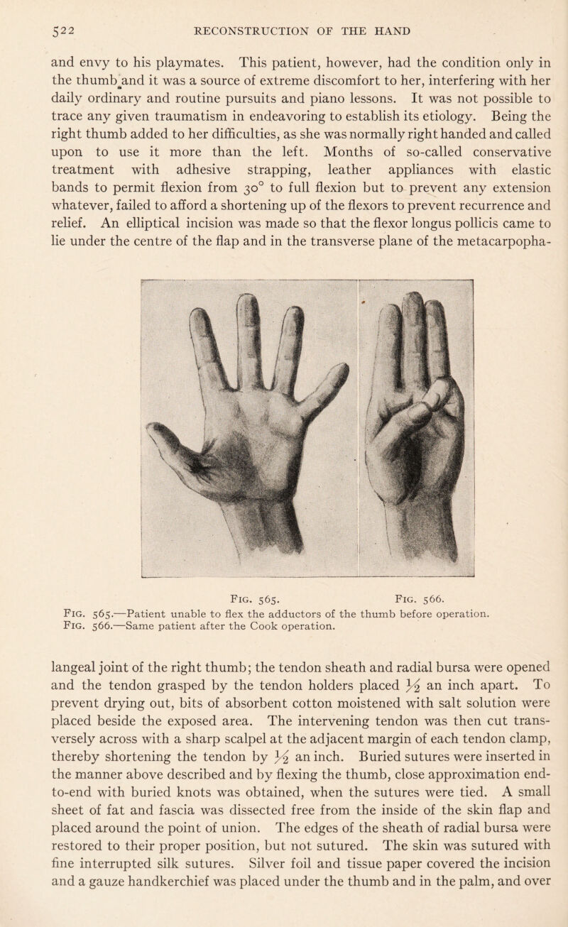 and envy to his playmates. This patient, however, had the condition only in the thumb^and it was a source of extreme discomfort to her, interfering with her daily ordinary and routine pursuits and piano lessons. It was not possible to trace any given traumatism in endeavoring to establish its etiology. Being the right thumb added to her difficulties, as she was normally right handed and called upon to use it more than the left. Months of so-called conservative treatment with adhesive strapping, leather appliances with elastic bands to permit flexion from 30° to full flexion but to prevent any extension whatever, failed to afford a shortening up of the flexors to prevent recurrence and relief. An elliptical incision was made so that the flexor longus pollicis came to lie under the centre of the flap and in the transverse plane of the metacarpopha- Fig. 565. Fig. 566. Fig. 565.—Patient unable to flex the adductors of the thumb before operation. Fig. 566.—Same patient after the Cook operation. langeal joint of the right thumb; the tendon sheath and radial bursa were opened and the tendon grasped by the tendon holders placed an inch apart. To prevent drying out, bits of absorbent cotton moistened with salt solution were placed beside the exposed area. The intervening tendon was then cut trans¬ versely across with a sharp scalpel at the adjacent margin of each tendon clamp, thereby shortening the tendon by 3^ an inch. Buried sutures were inserted in the manner above described and by flexing the thumb, close approximation end- to-end with buried knots was obtained, when the sutures were tied. A small sheet of fat and fascia was dissected free from the inside of the skin flap and placed around the point of union. The edges of the sheath of radial bursa were restored to their proper position, but not sutured. The skin was sutured with fine interrupted silk sutures. Silver foil and tissue paper covered the incision and a gauze handkerchief was placed under the thumb and in the palm, and over