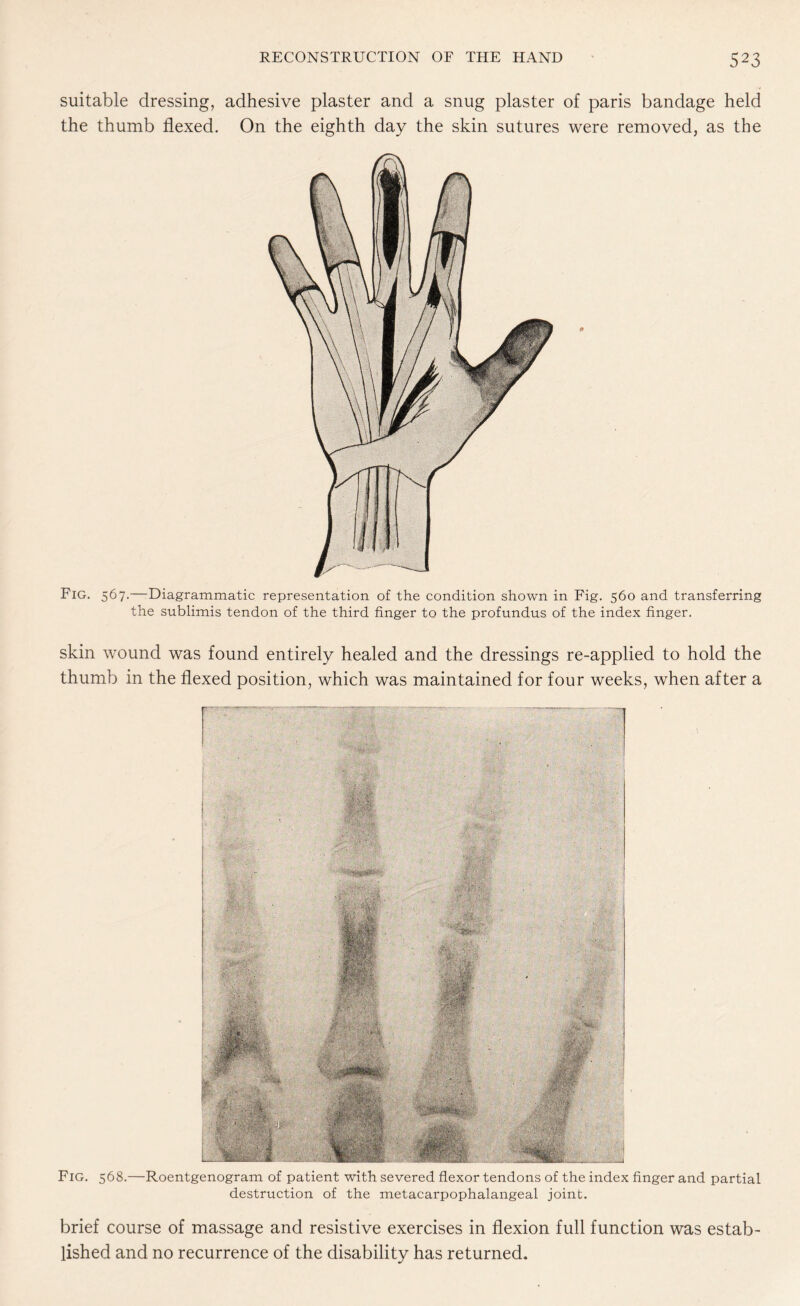 suitable dressing, adhesive plaster and a snug plaster of paris bandage held the thumb flexed. On the eighth day the skin sutures were removed, as the Fig. 567.—Diagrammatic representation of the condition shown in Fig. 560 and transferring the sublimis tendon of the third finger to the profundus of the index finger. skin wound was found entirely healed and the dressings re-applied to hold the thumb in the flexed position, which was maintained for four weeks, when after a Fig. 568.—Roentgenogram of patient with severed flexor tendons of the index finger and partial destruction of the metacarpophalangeal joint. brief course of massage and resistive exercises in flexion full function was estab¬ lished and no recurrence of the disability has returned.