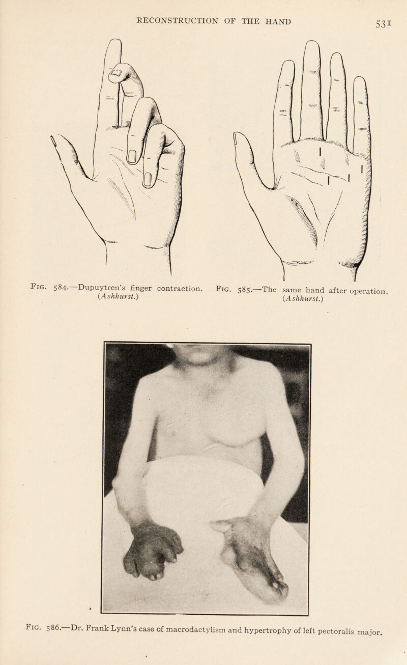 Fig. 584. Dupuytren’s finger contraction. Fig. 585.—The same hand after operation. (Ashhurst.) (Ashhurst.) Fig. 586. Dr. Frank Lynn's case of macrodactylism and hypertrophy of left pectoralis major.