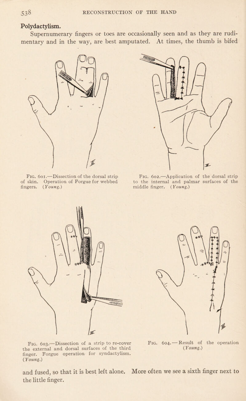 Polydactylism. Supernumerary fingers or toes are occasionally seen and as they are rudi¬ mentary and in the way, are best amputated. At times, the thumb is bifed Fig. 6oi.—Dissection of the dorsal strip of skin. Operation of Forguefor webbed fingers. (Young.) Fig. 602.—Application of the dorsal strip to the internal and palmar surfaces of the middle finger. (Young.) Fig. 603.—Dissection of a strip to re-cover Fig. 604. — Result of the operation the external and dorsal surfaces of the third (Young.) finger. Forgue operation for syndactylism. (Young.) and fused, so that it is best left alone. More often we see a sixth finger next to the little finger.