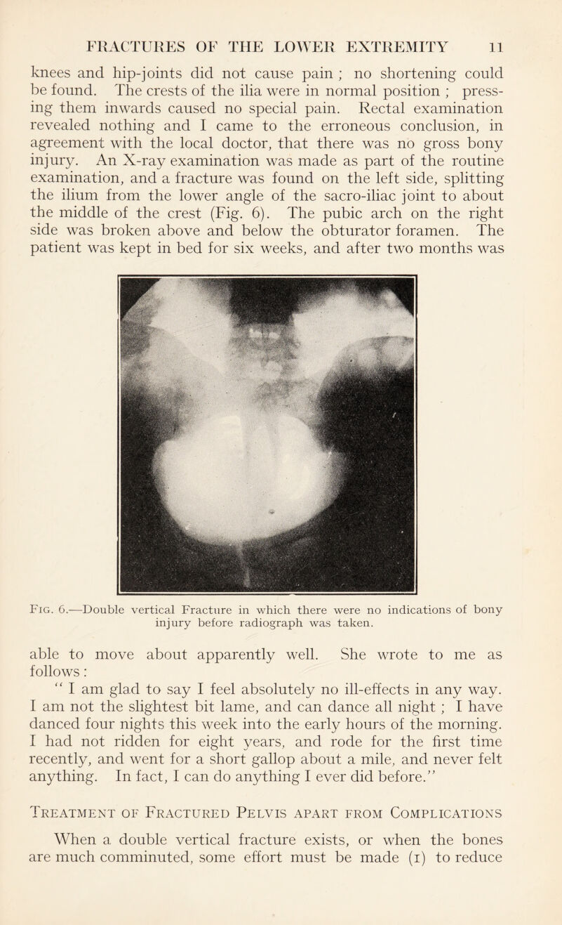 knees and hip-joints did not cause pain ; no shortening could be found. The crests of the ilia were in normal position ; press¬ ing them inwards caused no special pain. Rectal examination revealed nothing and I came to the erroneous conclusion, in agreement with the local doctor, that there was no gross bony injury. An X-ray examination was made as part of the routine examination, and a fracture was found on the left side, splitting the ilium from the lower angle of the sacro-iliac joint to about the middle of the crest (Fig. 6). The pubic arch on the right side was broken above and below the obturator foramen. The patient was kept in bed for six weeks, and after two months was Fig. 6.—Double vertical Fracture in which there were no indications of bony injury before radiograph was taken. able to move about apparently well. She wrote to me as follows: “ I am glad to say I feel absolutely no ill-effects in any way. I am not the slightest bit lame, and can dance all night; I have danced four nights this week into the early hours of the morning. I had not ridden for eight years, and rode for the first time recently, and went for a short gallop about a mile, and never felt anything. In fact, I can do anything I ever did before/' Treatment of Fractured Pelvis apart from Complications When a double vertical fracture exists, or when the bones are much comminuted, some effort must be made (i) to reduce