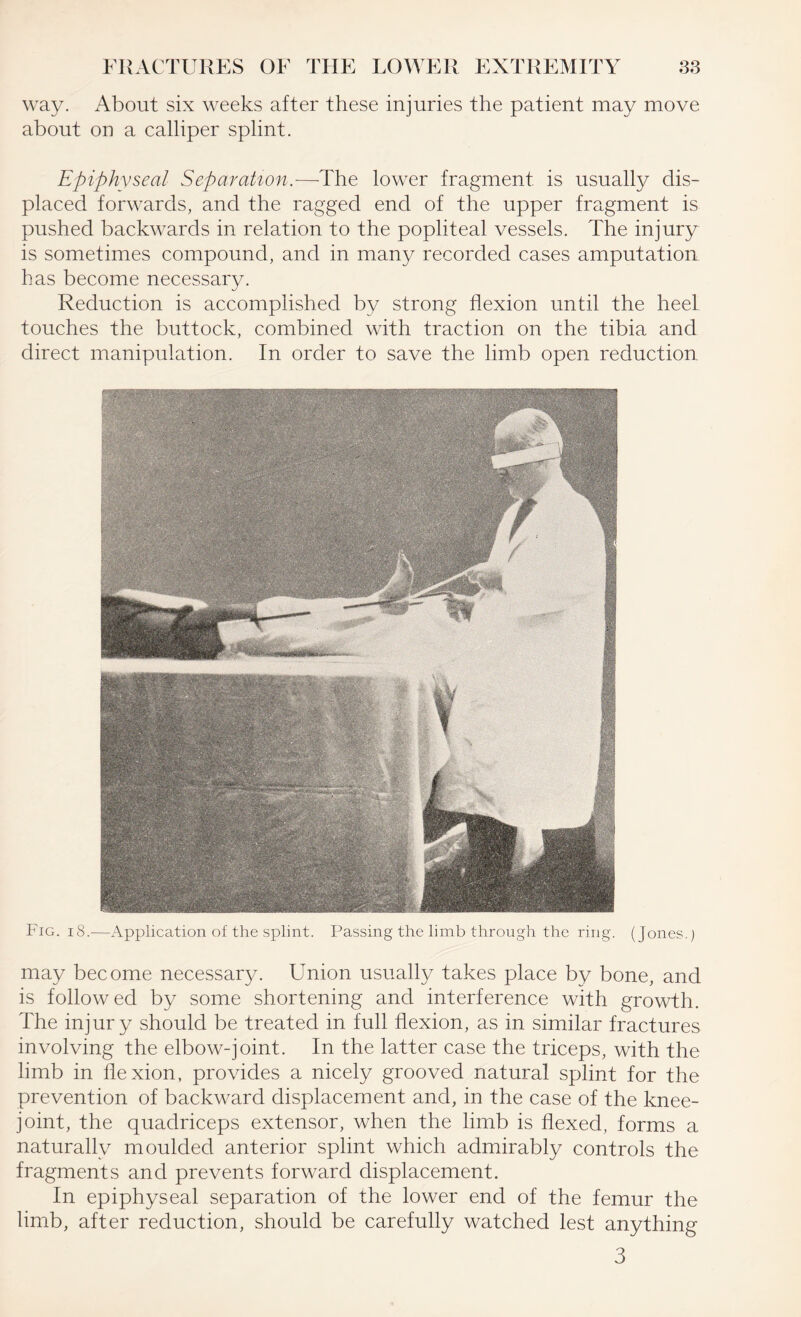 way. About six weeks after these injuries the patient may move about on a calliper splint. Epiphyseal Separation.—The lower fragment is usually dis¬ placed forwards, and the ragged end of the upper fragment is pushed backwards in relation to the popliteal vessels. The injury is sometimes compound, and in many recorded cases amputation has become necessary. Reduction is accomplished by strong flexion until the heel touches the buttock, combined with traction on the tibia and direct manipulation. In order to save the limb open reduction Fig. 18.—Application of the splint. Passing the limb through the ring. (Jones.) may become necessary. Union usually takes place by bone, and is followed by some shortening and interference with growth. The injury should be treated in full flexion, as in similar fractures involving the elbow-joint. In the latter case the triceps, with the limb in flexion, provides a nicely grooved natural splint for the prevention of backward displacement and, in the case of the knee- joint, the quadriceps extensor, when the limb is flexed, forms a naturally moulded anterior splint which admirably controls the fragments and prevents forward displacement. In epiphyseal separation of the lower end of the femur the limb, after reduction, should be carefully watched lest anything 3
