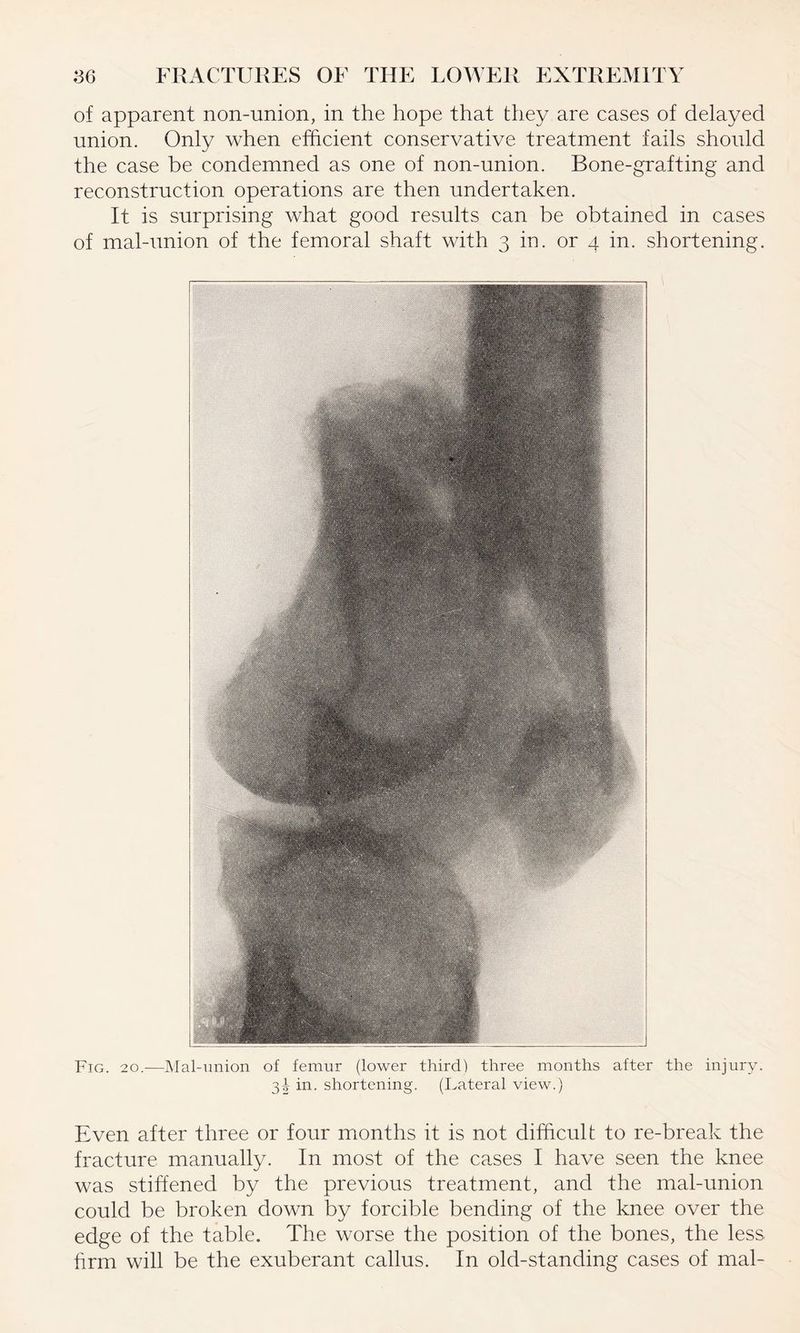 of apparent non-union, in the hope that they are cases of delayed union. Only when efficient conservative treatment fails should the case be condemned as one of non-union. Bone-grafting and reconstruction operations are then undertaken. It is surprising what good results can be obtained in cases of mal-union of the femoral shaft with 3 in. or 4 in. shortening. Fig. 20.-—Mal-union of femur (lower third) three months after the injury. 3^ in. shortening. (Lateral view.) Even after three or four months it is not difficult to re-break the fracture manually. In most of the cases I have seen the knee was stiffened by the previous treatment, and the mal-union could be broken down by forcible bending of the knee over the edge of the table. The worse the position of the bones, the less hrm will be the exuberant callus. In old-standing cases of mal-