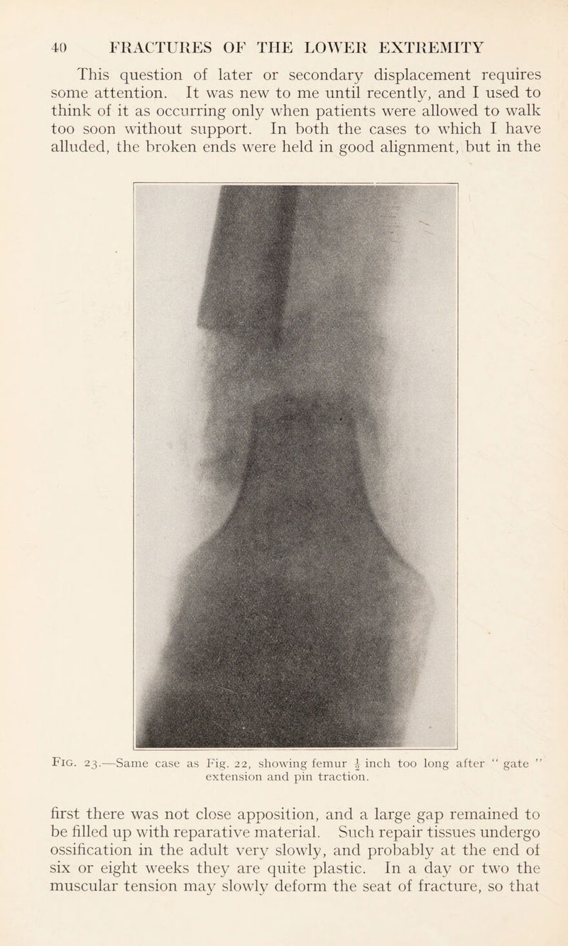 This question of later or secondary displacement requires some attention. It was new to me until recently, and I used to think of it as occurring only when patients were allowed to walk too soon without support. In both the cases to which I have alluded, the broken ends were held in good alignment, but in the Fig. 23.—Same case as Fig. 22, showing femur \ inch too long after “ gate ” extension and pin traction. first there was not close apposition, and a large gap remained to be filled up with reparative material. Such repair tissues undergo ossification in the adult very slowly, and probably at the end of six or eight weeks they are quite plastic. In a day or two the muscular tension may slowly deform the seat of fracture, so that