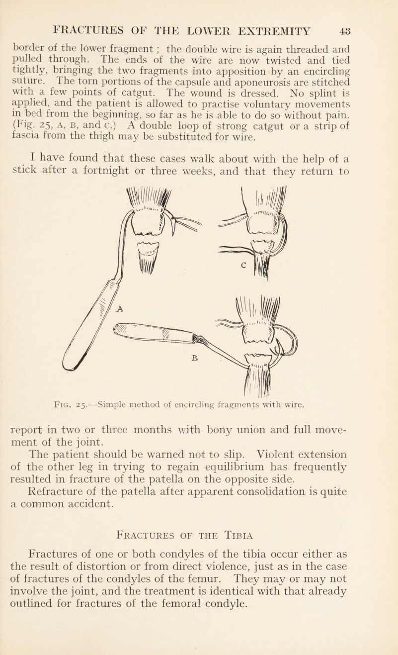 border of the lower fragment ; the double wire is again threaded and pulled through, the ends of the wire are now twisted and tied tightly, bringing the two fragments into apposition by an encircling suture. The torn portions of the capsule and aponeurosis are stitched with a few points of catgut. The wound is dressed. No splint is applied, and the patient is allowed to practise voluntary movements in bed from the beginning, so far as he is able to do so without pain. (Fig. 25, A, b, and c.) A double loop of strong catgut or a strip of fascia from the thigh may be substituted for wire. I have found that these cases walk about with the help of a stick after a fortnight or three weeks, and that they return to Fig. 25.—Simple method of encircling fragments with wire. report in two or three months with bony union and full move¬ ment of the joint. The patient should be warned not to slip. Violent extension of the other leg in trying to regain equilibrium has frequently resulted in fracture of the patella on the opposite side. Refracture of the patella after apparent consolidation is quite a common accident. Fractures of the Tibia Fractures of one or both condyles of the tibia occur either as the result of distortion or from direct violence, just as in the case of fractures of the condyles of the femur. They may or may not involve the joint, and the treatment is identical with that already outlined for fractures of the femoral condyle.