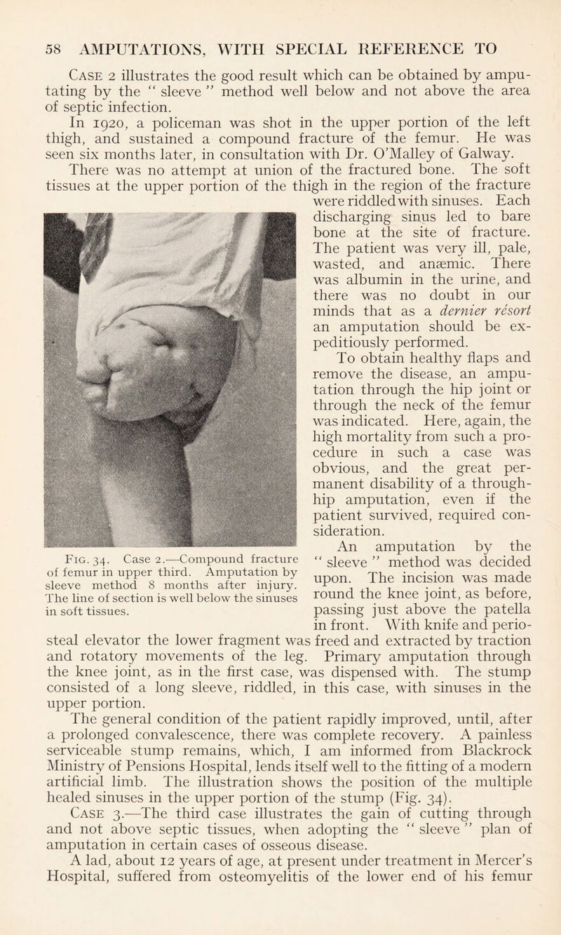 Case 2 illustrates the good result which can be obtained by ampu¬ tating by the “ sleeve ” method well below and not above the area of septic infection. In 1920, a policeman was shot in the upper portion of the left thigh, and sustained a compound fracture of the femur. He was seen six months later, in consultation with Dr. O’Malley of Galway. There was no attempt at union of the fractured bone. The soft tissues at the upper portion of the thigh in the region of the fracture were riddled with sinuses. Each § ’ - <& discharging sinus led to bare bone at the site of fracture. ^ W JB9 The patient was very ill, pale, # JT JHHj wasted, and anaemic. There f was aT>umin the urine, and .— there was no doubt in our minds that as a dernier resort an amputation should be ex¬ peditiously performed. To obtain healthy flaps and remove the disease, an ampu¬ tation through the hip joint or through the neck of the femur was indicated. Here, again, the high mortality from such a pro¬ cedure in such a case was obvious, and the great per¬ manent disability of a through- hip amputation, even if the patient survived, required con¬ sideration. An amputation by the “ sleeve ” method was decided upon. The incision was made round the knee joint, as before, passing just above the patella in front. With knife and perio¬ steal elevator the lower fragment was freed and extracted by traction and rotatory movements of the leg. Primary amputation through the knee joint, as in the first case, was dispensed with. The stump consisted of a long sleeve, riddled, in this case, with sinuses in the upper portion. The general condition of the patient rapidly improved, until, after a prolonged convalescence, there was complete recovery. A painless serviceable stump remains, which, I am informed from Blackrock Ministry of Pensions Hospital, lends itself well to the fitting of a modern artificial limb. The illustration shows the position of the multiple healed sinuses in the upper portion of the stump (Fig. 34). Case 3.—The third case illustrates the gain of cutting through and not above septic tissues, when adopting the “ sleeve ” plan of amputation in certain cases of osseous disease. A lad, about 12 years of age, at present under treatment in Mercer’s Hospital, suffered from osteomyelitis of the lower end of his femur Fig. 34. Case 2.-—Compound fracture of femur in upper third. Amputation by sleeve method 8 months after injury. The line of section is well below the sinuses in soft tissues.