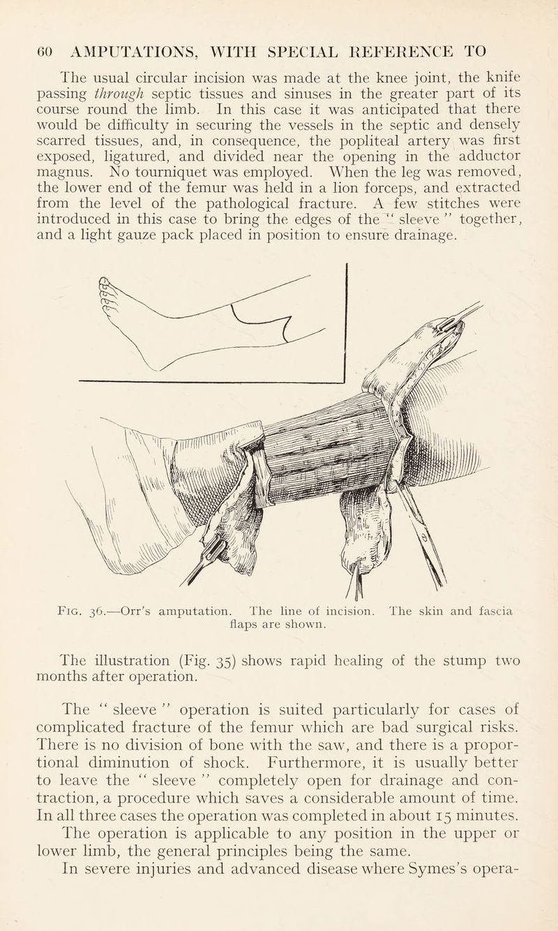The usual circular incision was made at the knee joint, the knife passing through septic tissues and sinuses in the greater part of its course round the limb. In this case it was anticipated that there would be difficulty in securing the vessels in the septic and densely scarred tissues, and, in consequence, the popliteal artery was first exposed, ligatured, and divided near the opening in the adductor magnus. No tourniquet was employed. When the leg was removed, the lower end of the femur was held in a lion forceps, and extracted from the level of the pathological fracture. A few stitches were introduced in this case to bring the edges of the “ sleeve ” together, and a light gauze pack placed in position to ensure drainage. Fig. 36.—Orr’s amputation. The line of incision. The skin and fascia flaps are shown. The illustration (Fig. 35) shows rapid healing of the stump two months after operation. The “ sleeve ” operation is suited particularly for cases of complicated fracture of the femur which are bad surgical risks. There is no division of bone with the saw, and there is a propor¬ tional diminution of shock. Furthermore, it is usually better to leave the “ sleeve ” completely open for drainage and con¬ traction, a procedure which saves a considerable amount of time. In all three cases the operation was completed in about 15 minutes. The operation is applicable to any position in the upper or lower limb, the general principles being the same. In severe injuries and advanced disease where Symes’s opera-