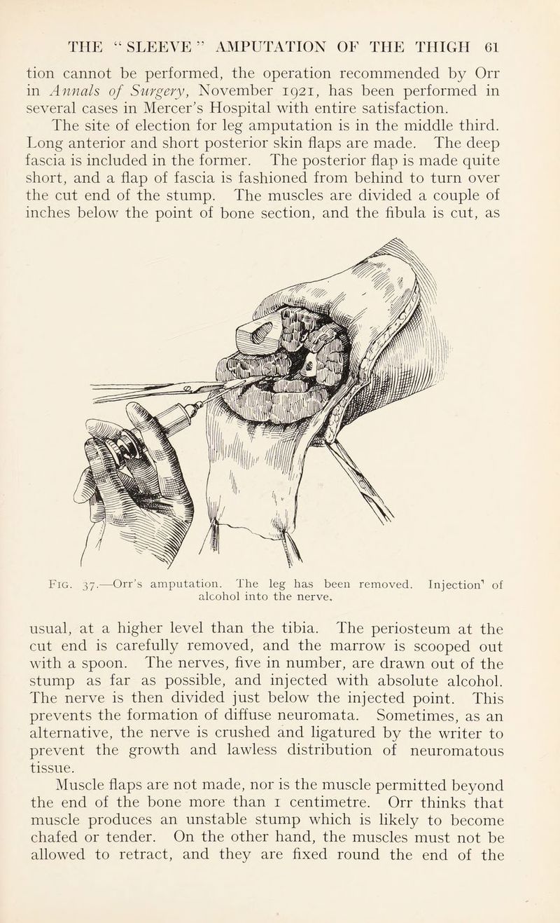 tion cannot be performed, the operation recommended by On- in Annals of Surgery, November 1921, has been performed in several cases in Mercer’s Hospital with entire satisfaction. The site of election for leg amputation is in the middle third. Long anterior and short posterior skin flaps are made. The deep fascia is included in the former. The posterior flap is made quite short, and a flap of fascia is fashioned from behind to turn over the cut end of the stump. The muscles are divided a couple of inches below the point of bone section, and the fibula is cut, as Fig. 37.—Orr’s amputation. The leg has been removed. Injection'1 of alcohol into the nerve. usual, at a higher level than the tibia. The periosteum at the cut end is carefully removed, and the marrow is scooped out with a spoon. The nerves, five in number, are drawn out of the stump as far as possible, and injected with absolute alcohol. The nerve is then divided just below the injected point. This prevents the formation of diffuse neuromata. Sometimes, as an alternative, the nerve is crushed and ligatured by the writer to prevent the growth and lawless distribution of neuromatous tissue. Muscle flaps are not made, nor is the muscle permitted beyond the end of the bone more than 1 centimetre. Orr thinks that muscle produces an unstable stump which is likely to become chafed or tender. On the other hand, the muscles must not be allowed to retract, and they are fixed round the end of the