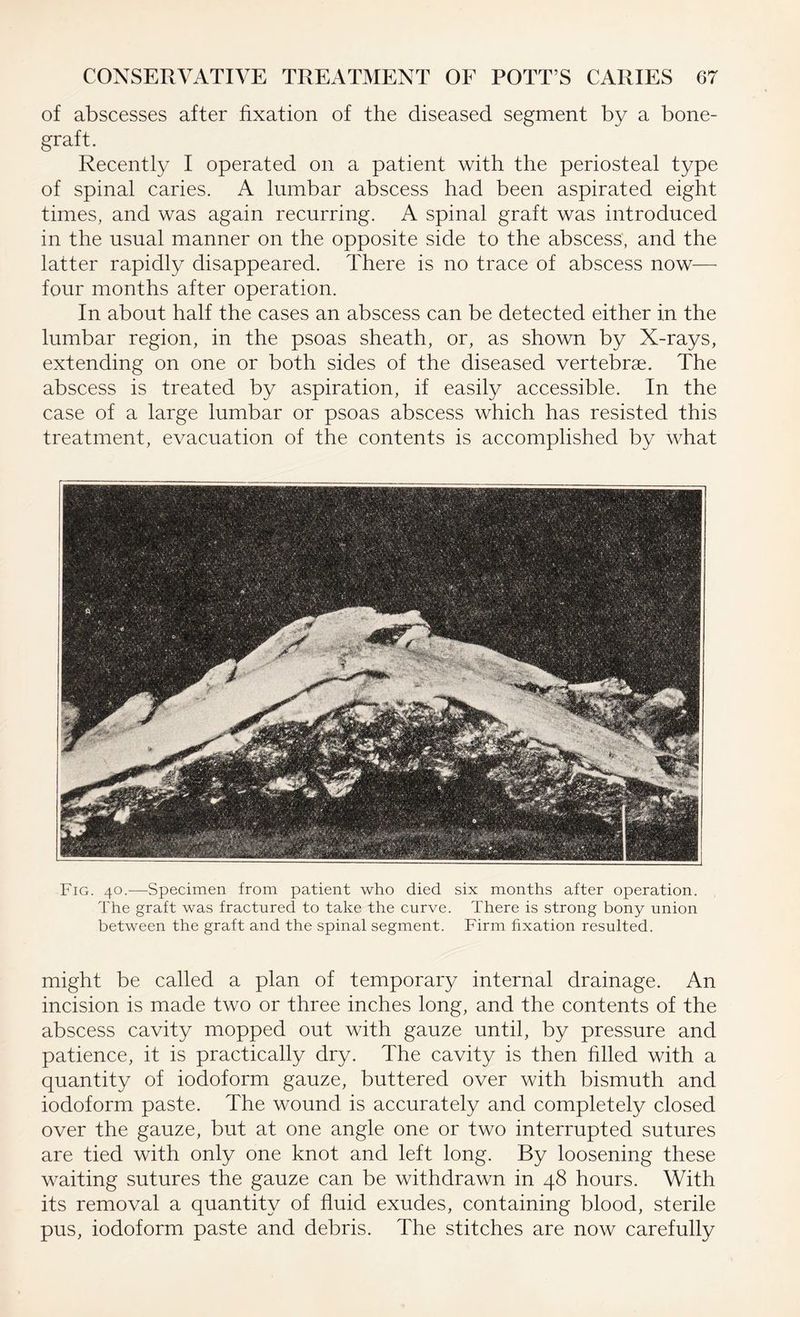 of abscesses after fixation of the diseased segment by a bone- graft. Recently I operated on a patient with the periosteal type of spinal caries. A lumbar abscess had been aspirated eight times, and was again recurring. A spinal graft was introduced in the usual manner on the opposite side to the abscess, and the latter rapidly disappeared. There is no trace of abscess now— four months after operation. In about half the cases an abscess can be detected either in the lumbar region, in the psoas sheath, or, as shown by X-rays, extending on one or both sides of the diseased vertebrae. The abscess is treated by aspiration, if easily accessible. In the case of a large lumbar or psoas abscess which has resisted this treatment, evacuation of the contents is accomplished by what Fig. 40.—Specimen from patient who died six months after operation. The graft was fractured to take the curve. There is strong bony union between the graft and the spinal segment. Firm fixation resulted. might be called a plan of temporary internal drainage. An incision is made two or three inches long, and the contents of the abscess cavity mopped out with gauze until, by pressure and patience, it is practically dry. The cavity is then filled with a quantity of iodoform gauze, buttered over with bismuth and iodoform paste. The wound is accurately and completely closed over the gauze, but at one angle one or two interrupted sutures are tied with only one knot and left long. By loosening these waiting sutures the gauze can be withdrawn in 48 hours. With its removal a quantity of fluid exudes, containing blood, sterile pus, iodoform paste and debris. The stitches are now carefully
