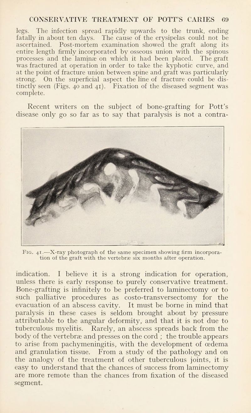 legs. The infection spread rapidly upwards to the trunk, ending fatally in about ten days. The cause of the erysipelas could not be ascertained. Post-mortem examination showed the graft along its entire length firmly incorporated by osseous union with the spinous processes and the laminae on which it had been placed. The graft was fractured at operation in order to take the kyphotic curve, and at the point of fracture union between spine and graft was particularly strong. On the superficial aspect the line of fracture could be dis¬ tinctly seen (Figs. 40 and 41). Fixation of the diseased segment was complete. Recent writers on the subject of bone-grafting for Pott’s disease only go so far as to say that paralysis is not a contra- Fig. 41.—X-ray photograph of the same specimen showing firm incorpora¬ tion of the graft with the vertebrae six months after operation. indication. I believe it is a strong indication for operation, unless there is early response to purely conservative treatment. Bone-grafting is infinitely to be preferred to laminectomy or to such palliative procedures as costo-transversectomy for the evacuation of an abscess cavity. It must be borne in mind that paralysis in these cases is seldom brought about by pressure attributable to the angular deformity, and that it is not due to tuberculous myelitis. Rarely, an abscess spreads back from the body of the vertebrae and presses on the cord ; the trouble appears to arise from pachymeningitis, with the development of oedema and granulation tissue. From a study of the pathology and on the analogy of the treatment of other tuberculous joints, it is easy to understand that the chances of success from laminectomy are more remote than the chances from fixation of the diseased segment.