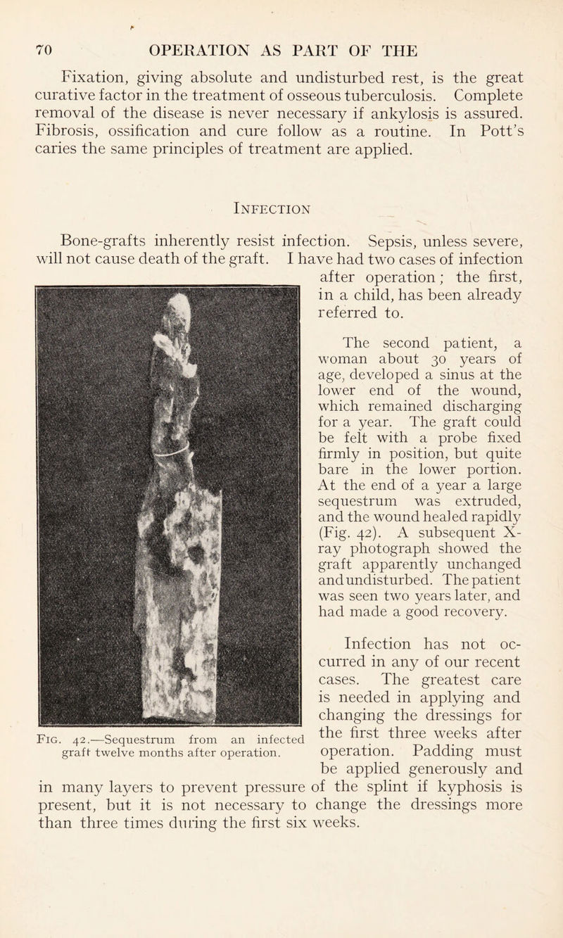 Fixation, giving absolute and undisturbed rest, is the great curative factor in the treatment of osseous tuberculosis. Complete removal of the disease is never necessary if ankylosis is assured. Fibrosis, ossification and cure follow as a routine. In Pott’s caries the same principles of treatment are applied. Infection Bone-grafts inherently resist infection. Sepsis, unless severe, will not cause death of the graft. I have had two cases of infection after operation; the first, in a child, has been already referred to. The second patient, a woman about 30 years of age, developed a sinus at the lower end of the wound, which remained discharging for a year. The graft could be felt with a probe fixed firmly in position, but quite bare in the lower portion. At the end of a year a large sequestrum was extruded, and the wound healed rapidly (Fig. 42). A subsequent X- ray photograph showed the graft apparently unchanged and undisturbed. The patient was seen two years later, and had made a good recovery. Infection has not oc¬ curred in any of our recent cases. The greatest care is needed in applying and changing the dressings for the first three weeks after operation. Padding must be applied generously and in many layers to prevent pressure of the splint if kyphosis is present, but it is not necessary to change the dressings more than three times during the first six weeks. Fig. 42.—Sequestrum from an infected graft- twelve months after operation.