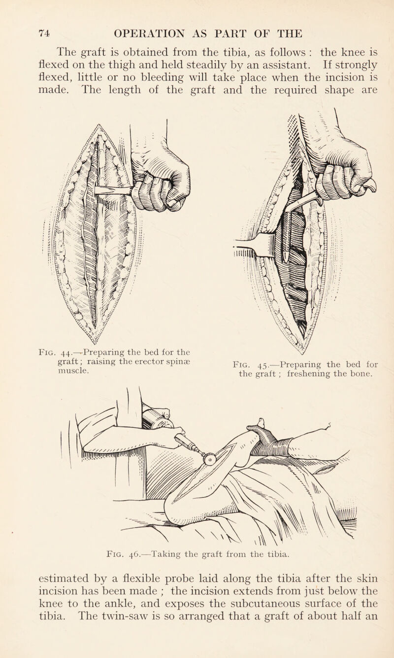 The graft is obtained from the tibia, as follows : the knee is flexed on the thigh and held steadily by an assistant. If strongly flexed, little or no bleeding will take place when the incision is made. The length of the graft and the required shape are Fig. 44.—-Preparing the bed for the graft; raising the erector spinae muscle. Fig. 46.—Taking the graft from the tibia. estimated by a flexible probe laid along the tibia after the skin incision has been made ; the incision extends from just below the knee to the ankle, and exposes the subcutaneous surface of the tibia. The twin-saw is so arranged that a graft of about half an